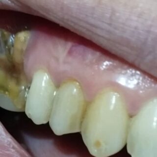 جذر سن مصاب ضمن مجموعة من الأسنان في الفم