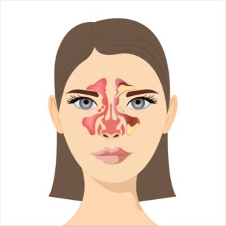 رسم توضيحي لوجه امرأة موضح به مناطق تواجد الجيبوب الأنفية على جانب الأنف وفوق العين