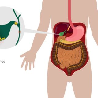 رسم توضيحي للجهاز الهضمي للإنسان حيث يظهر الحصيات داخل المرارة