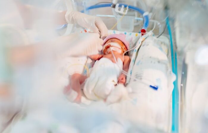 طفل خديج موجود في حضانة المستشفى موصول به العديد من الأسلاك والأنابيب الطبية