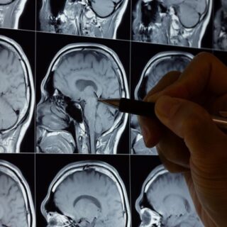 شخص يمسك بقلم ويشير به على صورة رنين مغناطيسي للدماغ