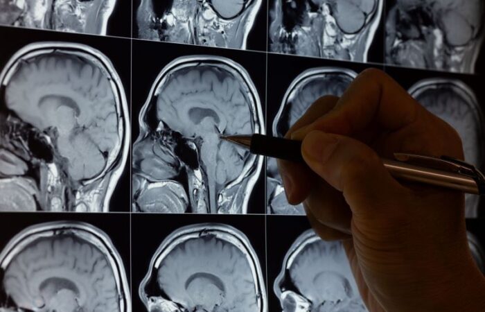 شخص يمسك بقلم ويشير به على صورة رنين مغناطيسي للدماغ
