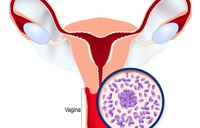 رسم توضيحي لالتهاب المهبل الجرثومي عند النساء
