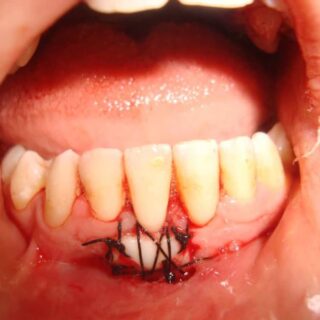 أسنان شخص بالغ حيث يظهر تطعيم وخياطة اللثة