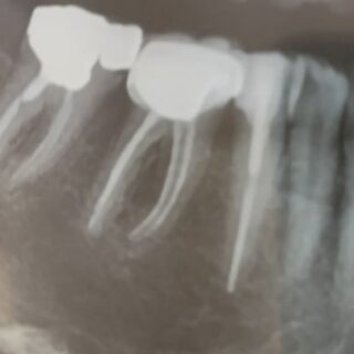 صورة أشعة سينية للأسنان