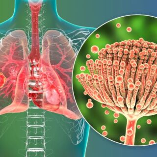 رسم توضيحي لجهاز التنفس عند الإنسان وفطر الرشاشيات المتمركز على الرئة