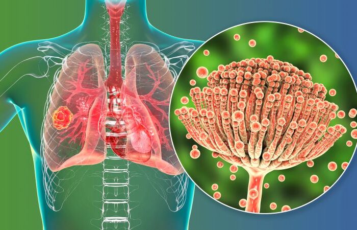 رسم توضيحي لجهاز التنفس عند الإنسان وفطر الرشاشيات المتمركز على الرئة