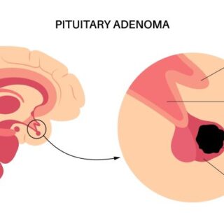 رسم توضيحي للمخيخ حيث تظهر الغدة النخامية مصابة بورم