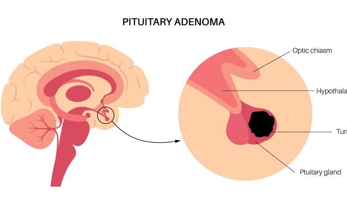 رسم توضيحي للمخيخ حيث تظهر الغدة النخامية مصابة بورم
