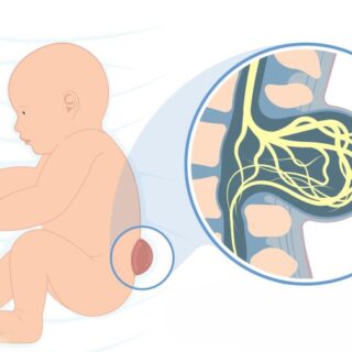 صورة توضيحية للنخاع الشوكي حيث يظهر تشكل عقدة بأخره