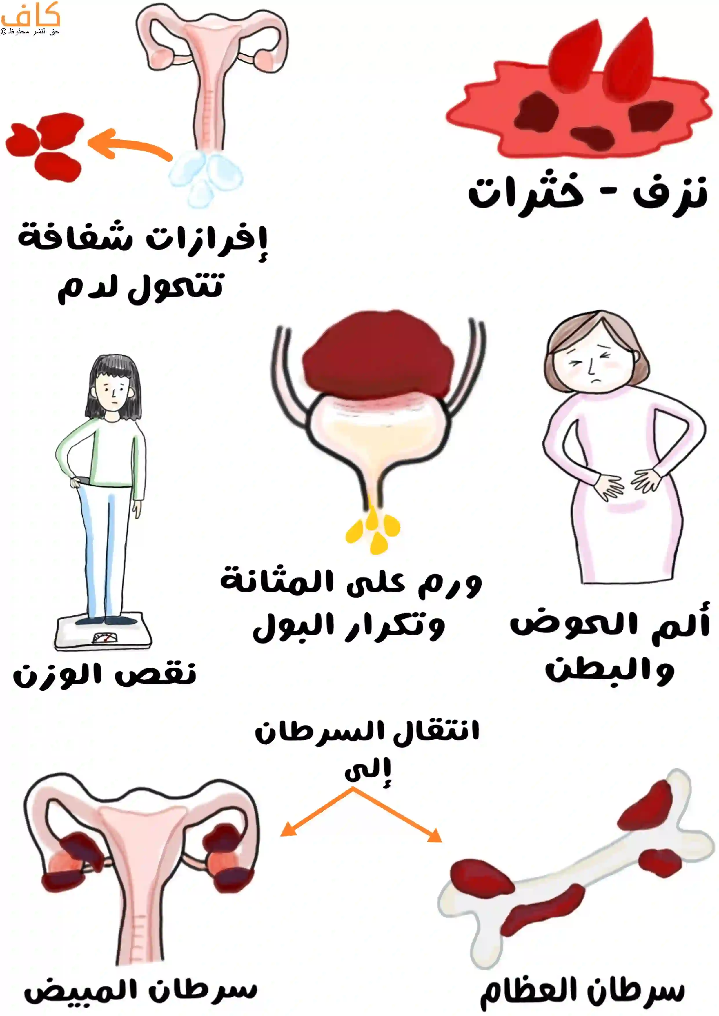 رسمة توضيحية ملوّنة تعرض أعراض سرطان الرحم مثل النزف المهبلي مع خثرات، الإفرازات الشفافة التي تتحول لدم، ألم في الحوض والبطن، نقص الوزن، تكرار التبول بسبب ضغط الورم على المثانة، إضافةً إلى انتقال السرطان للعظام والمبيضين.