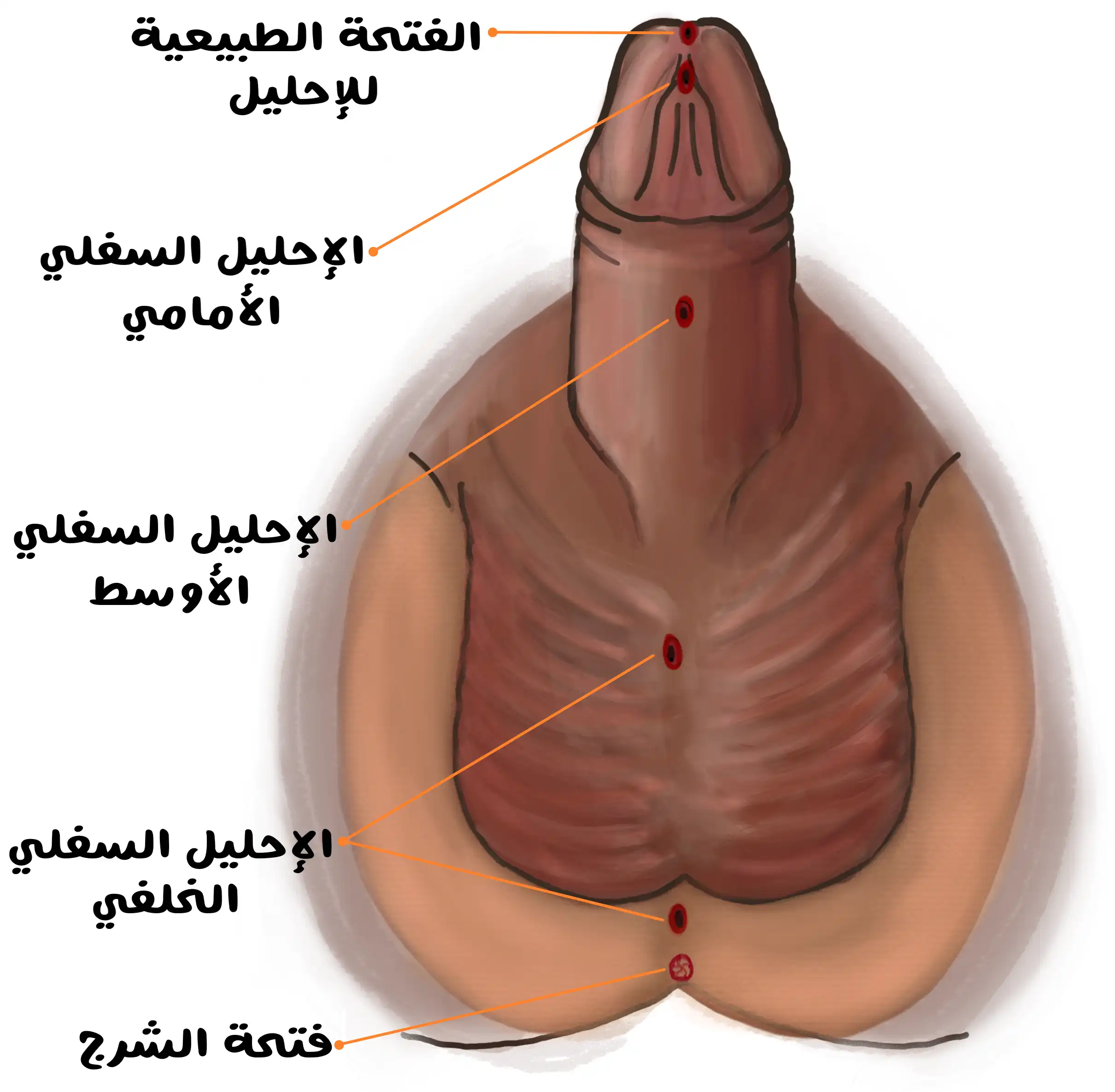 رسم طبي يوضح أنواع الإحليل السفلي عند الذكور: الفتحة الطبيعية للإحليل، الإحليل السفلي الأمامي، الإحليل السفلي الأوسط، الإحليل السفلي الخلفي، وفتحة الشرج