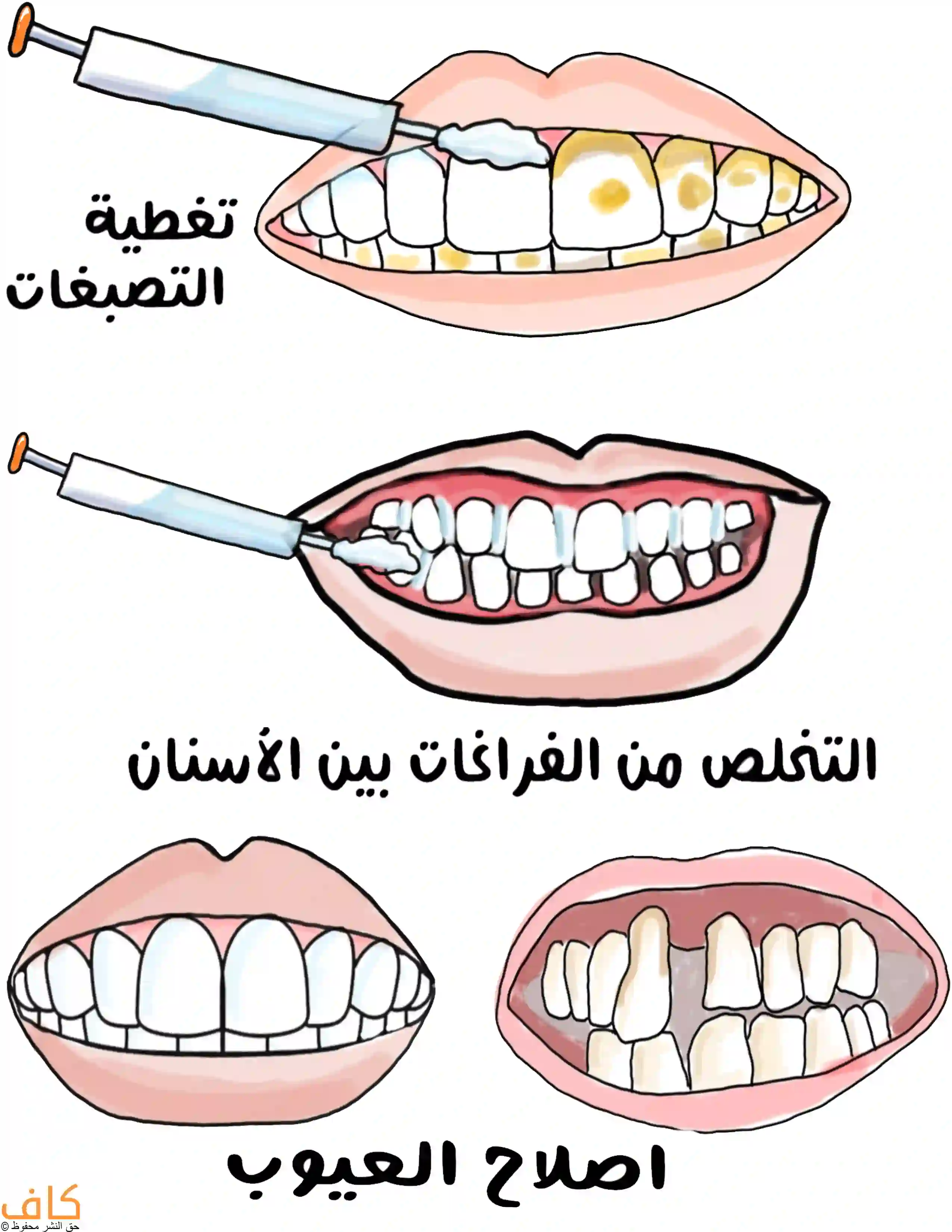 رسم توضيحي يوضح ثلاثة استخدامات للوجوه التجميلية للأسنان:
الأول تغطية التصبغات الصفراء والبقع على الأسنان الأمامية،
الثاني سد الفراغات الصغيرة بين الأسنان باستخدام مادة تجميلية،
والثالث إصلاح العيوب الشكلية للأسنان غير المنتظمة للحصول على مظهر أكثر جمالاً.