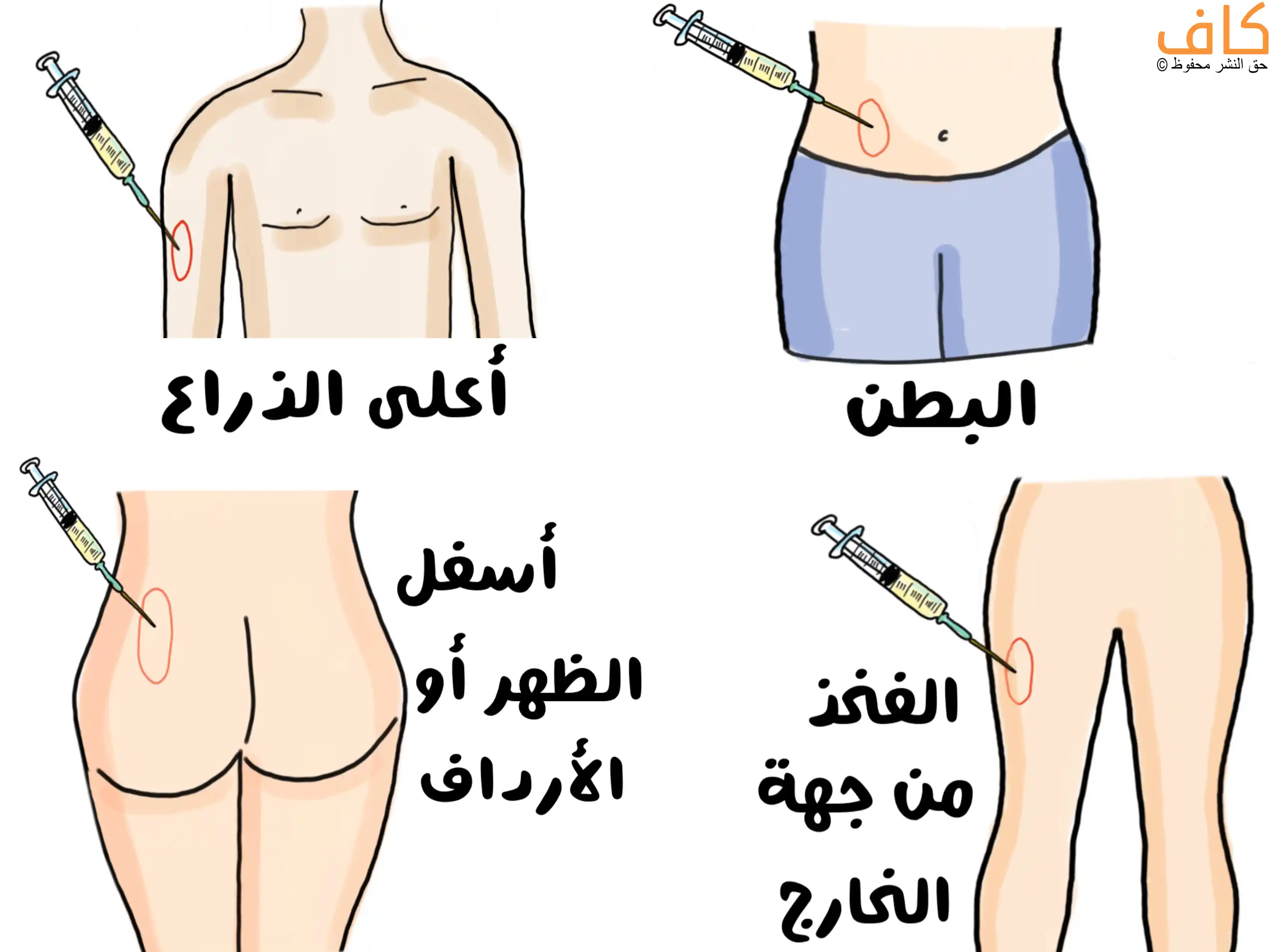 جسم إنسان مرسوم يُظهر مواقع حقن الأنسولين مع إبرة في أعلى الذراع، إبرة في البطن، إبرة في أسفل الظهر أو الأرداف، وإبرة في الفخذ من الجهة الخارجية،