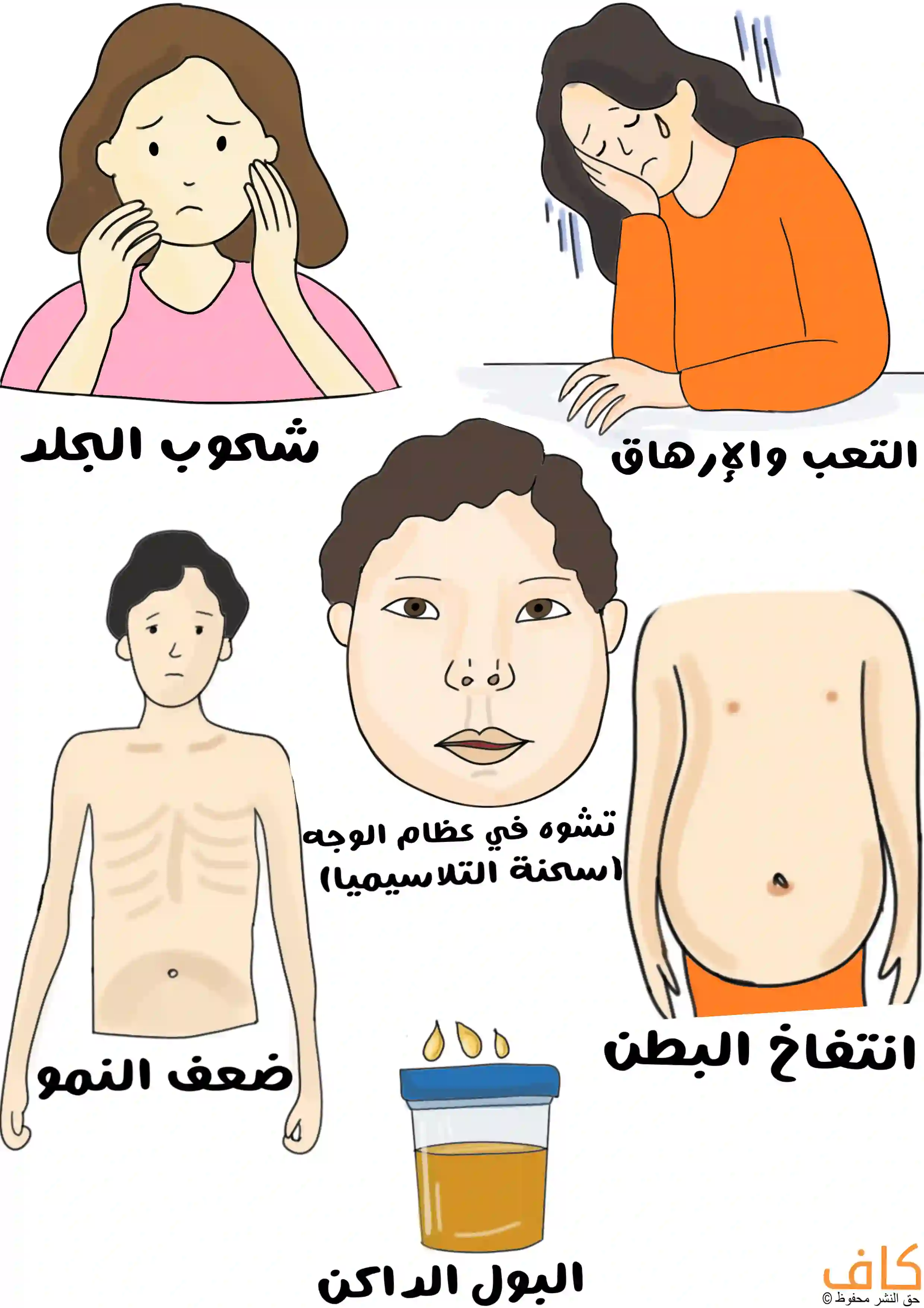 رسم توضيحي يُظهر عدة أشخاص يعانون من علامات مختلفة مثل شحوب الجلد، التعب والإرهاق، انتفاخ البطن، ضعف النمو، وتشوه في عظام الوجه مع وعاء بول داكن اللون، ويُعبّر عن الأعراض الجسدية المميزة لمرض الثلاسيميا.