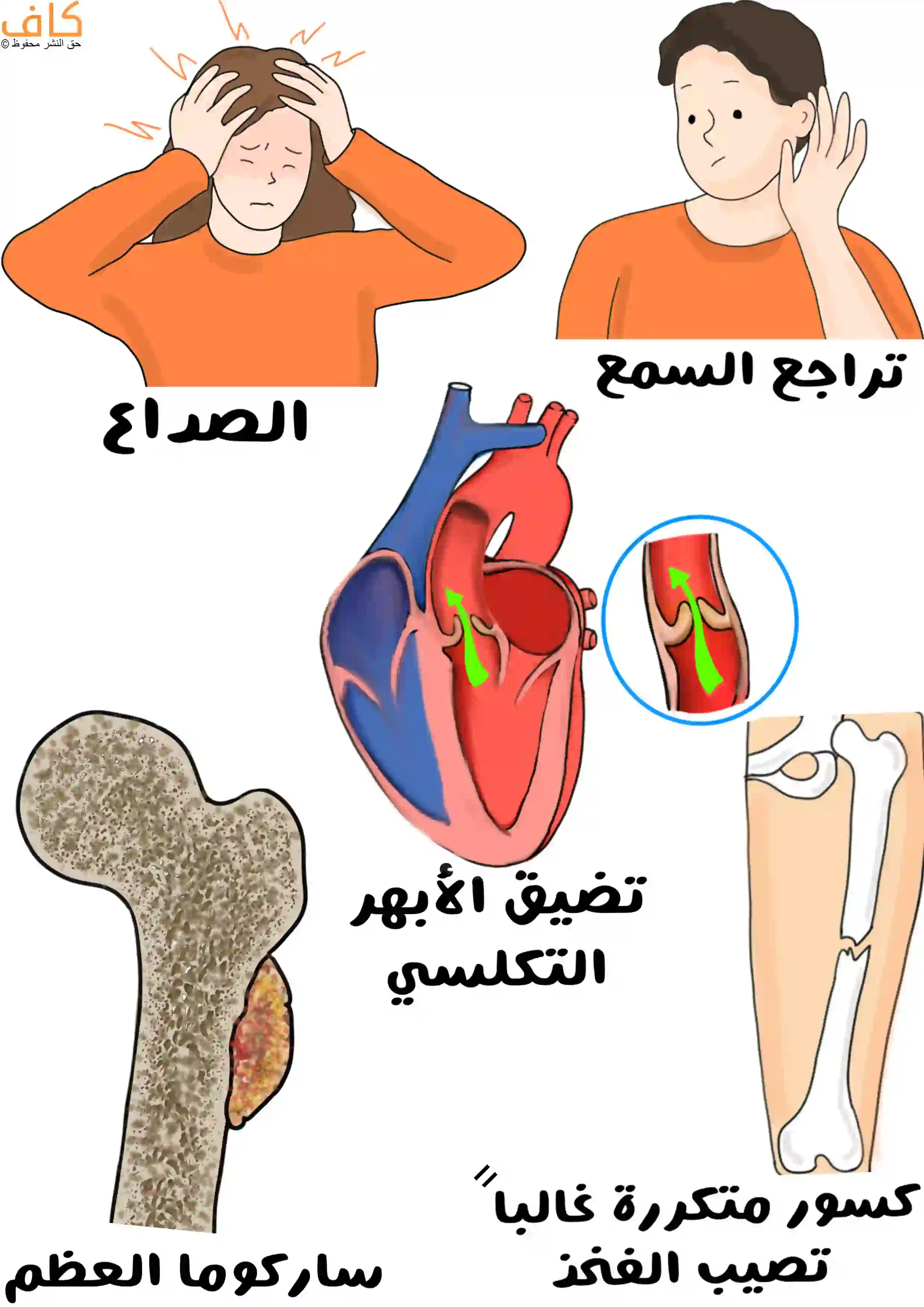 صورة توضيحية تبيّن امرأة تمسك رأسها متألمة من الصداع، رجل يضع يده على أذنه دلالة على ضعف السمع، رسم تشريحي للقلب والشريان الأبهر لشرح التضيّق التكلّسي، عظم يظهر عليه ورم سرطاني، وعظم فخذ مكسور يوضح الكسور المتكررة المرتبطة بالمرض.