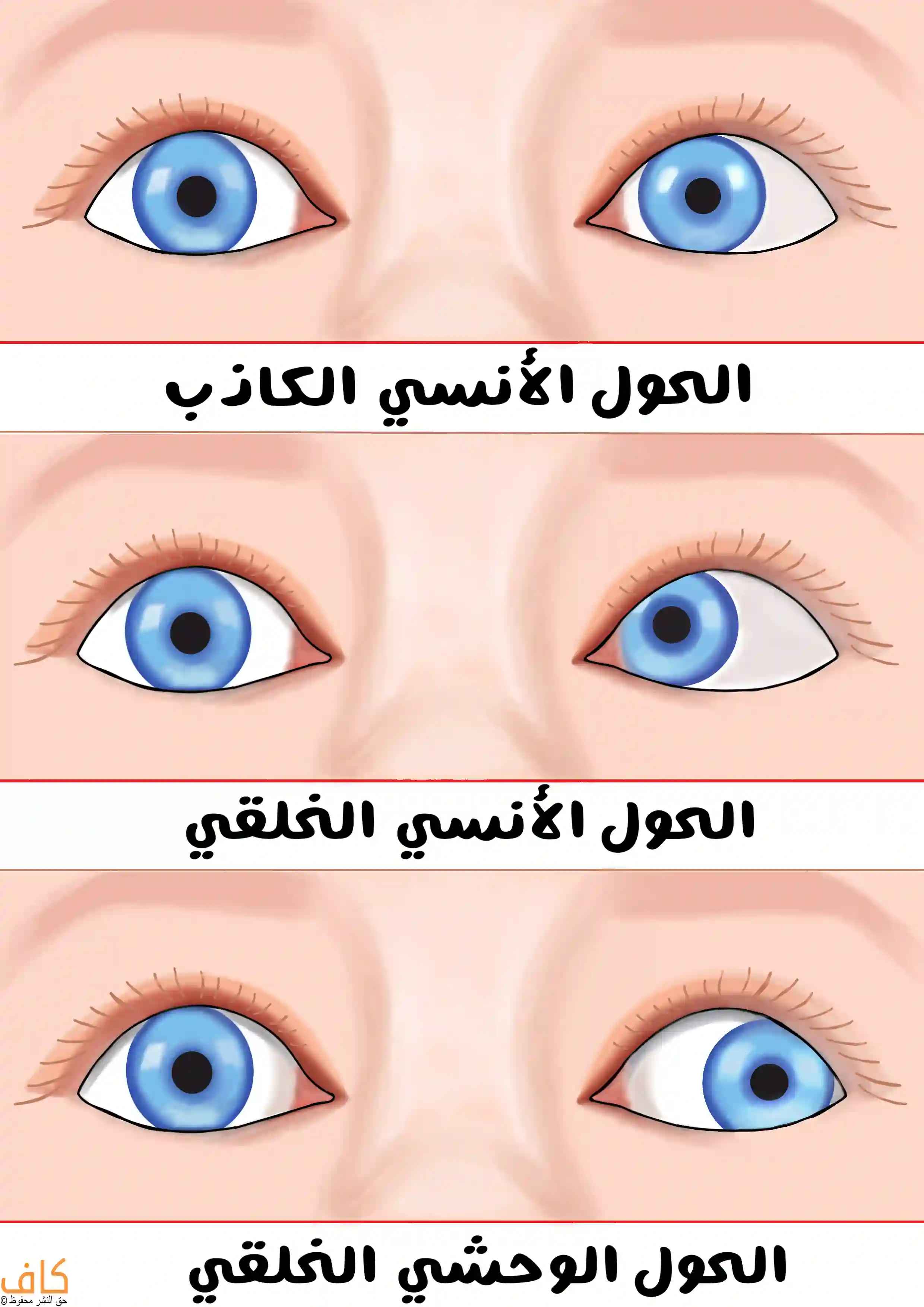 رسم توضيحي يُظهر ثلاثة أزواج من العيون البشرية بأوضاع مختلفة لمحور النظر، يُبيّن في الأعلى العيون في حالة الحول الأنسي الكاذب وفيها تنحرف العين نحو الداخل، وفي المنتصف الحول الأنسي الخلقي ووفي هذه الحالة تنحرف العين بشكل أكبر نحو الداخل، أما في الأسفل فيوجد الحول الوحشي الخلقي وتتجه العين في هذه الحالة تماما نحو الخارج.