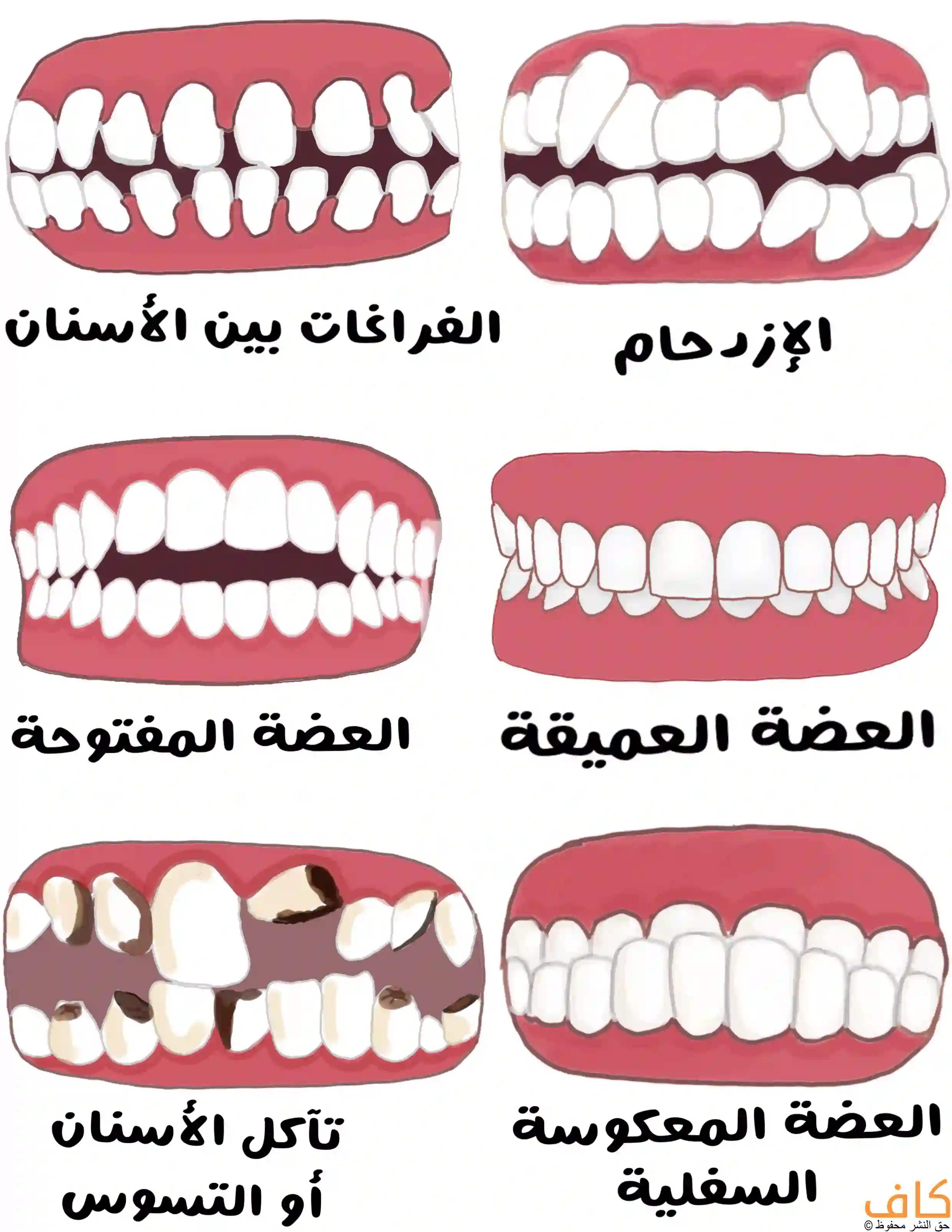 رسم توضيحي يُظهر ستة أنواع من مشكلات الأسنان التي تستدعي علاجًا تقويميًا، وتشمل الفُراغات بين الأسنان في كلا الفكين السفلي والعلوي، والإزدحام بين الأسنان وتراكبها فوق بعضها البعض، والعضة المفتوحة وتبدو على شكل فراغ بين الاسنان العلوية والسفلية رغم انطباق الفكين، والعضة العميقة التي تغطي فيها اسنان الفك العلوي لأسنان الفك السفلي، وتآكل الأسنان أو التسوس، والعضة المعكوسة السفلية.