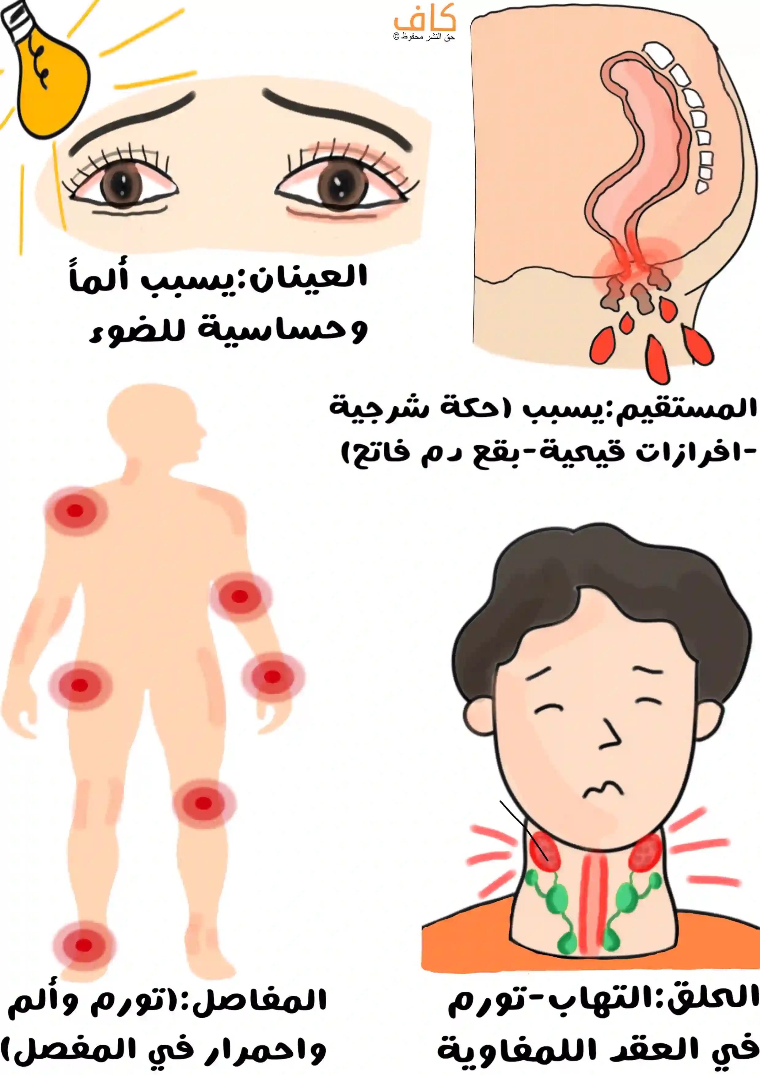 صورة توضيحية تُظهر رسومات للأعضاء التي قد يصيبها السيلان البني، منها عينان حمراء تدلان على الألم وحساسية الضوء، ومقطع تشريحي للمستقيم يبيّن إفرازات ودماء، وشخص يعاني من التهاب وتورم في الحلق والعقد اللمفاوية، وجسم يُظهر دوائر حمراء على المفاصل للدلالة على التورم والألم.