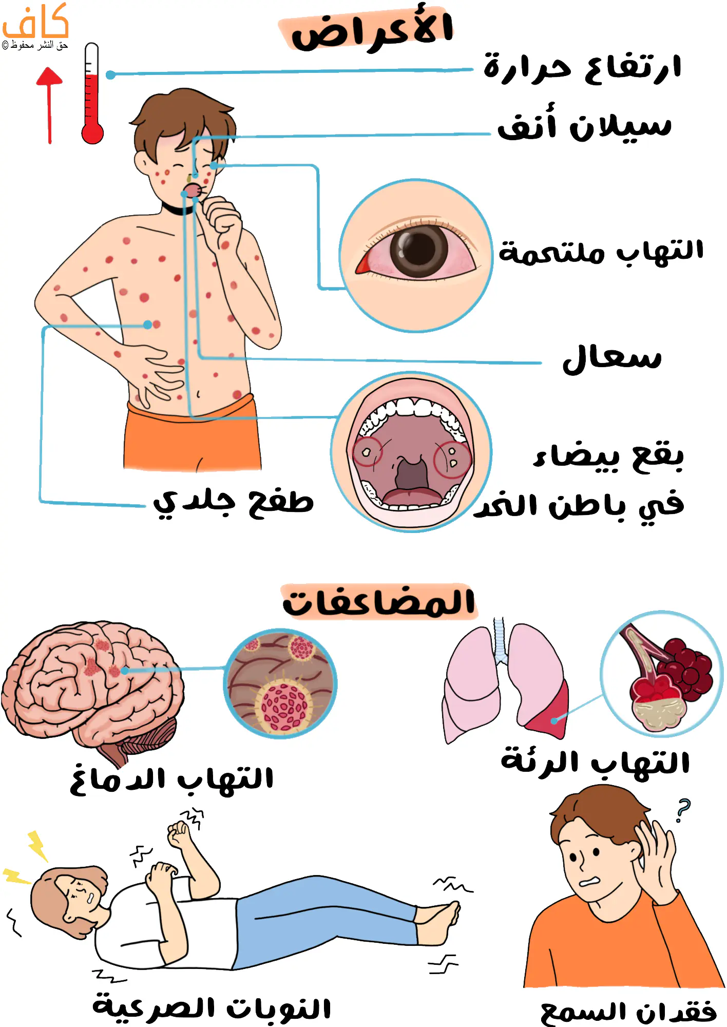 رسم توضيحي يُظهر طفلًا مصابًا بالحصبة تظهر على جسمه بقع حمراء مع أعراض تشمل الحمى وسيلان الأنف والتهاب الملتحمة والسعال وظهور بقع بيضاء في باطن الخد ضمن الحفرة الفموية، ويُظهر أيضًا حويصلات رئوية عليها التهابات، ورسمة تشريحية للدماغ تظهر على نقاط حمراء، بالإضافة لفتاة مستلقية على ظهرها على الأرض وترتعش.