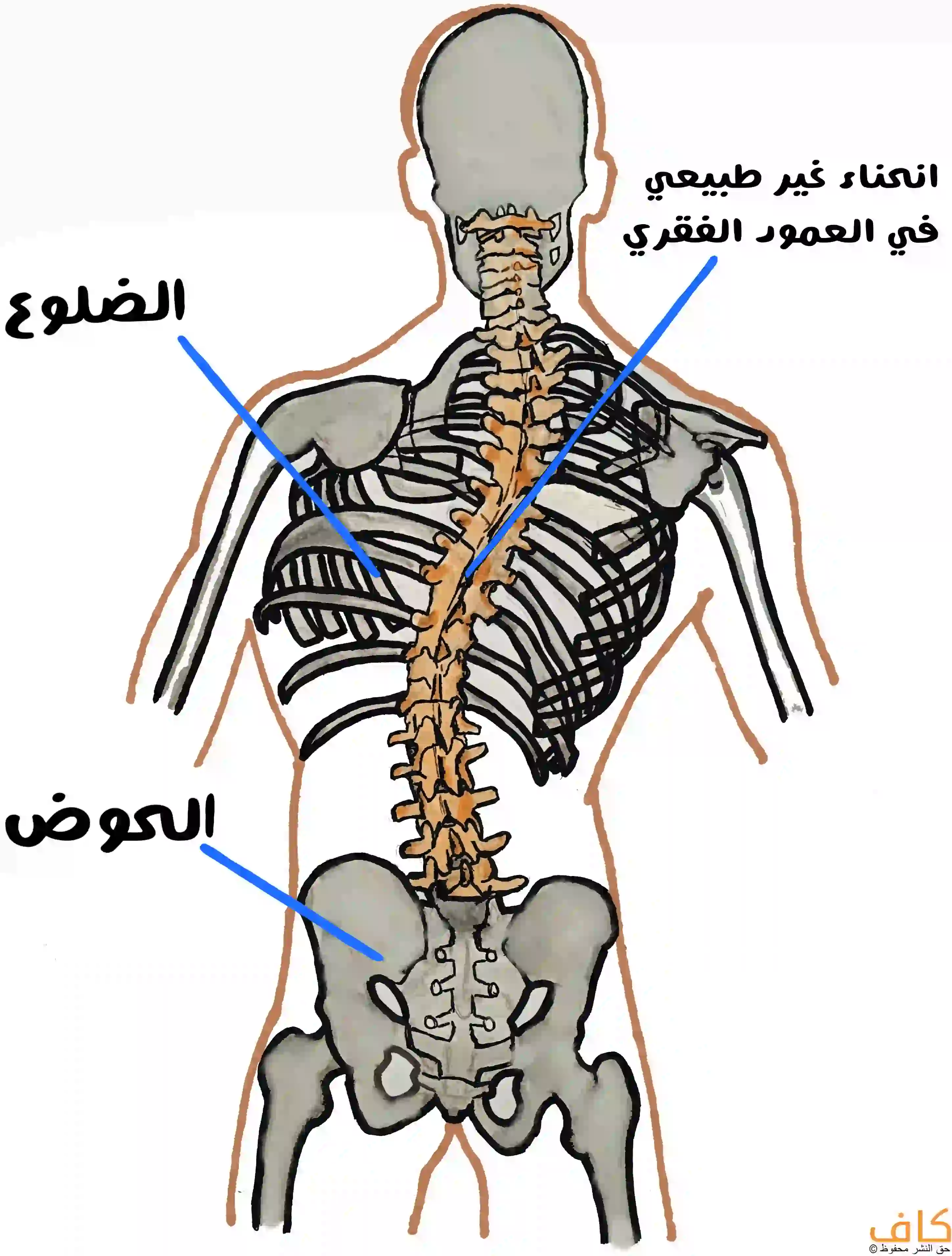 رسم توضيحي يُظهر الهيكل العظمي من الخلف مع انحناء غير طبيعي في العمود الفقري يمتد من الرقبة إلى الحوض، مع الإشارة إلى الضلوع والحوض، ويُعبّر عن حالة الجنف أو انحناء العمود الفقري.