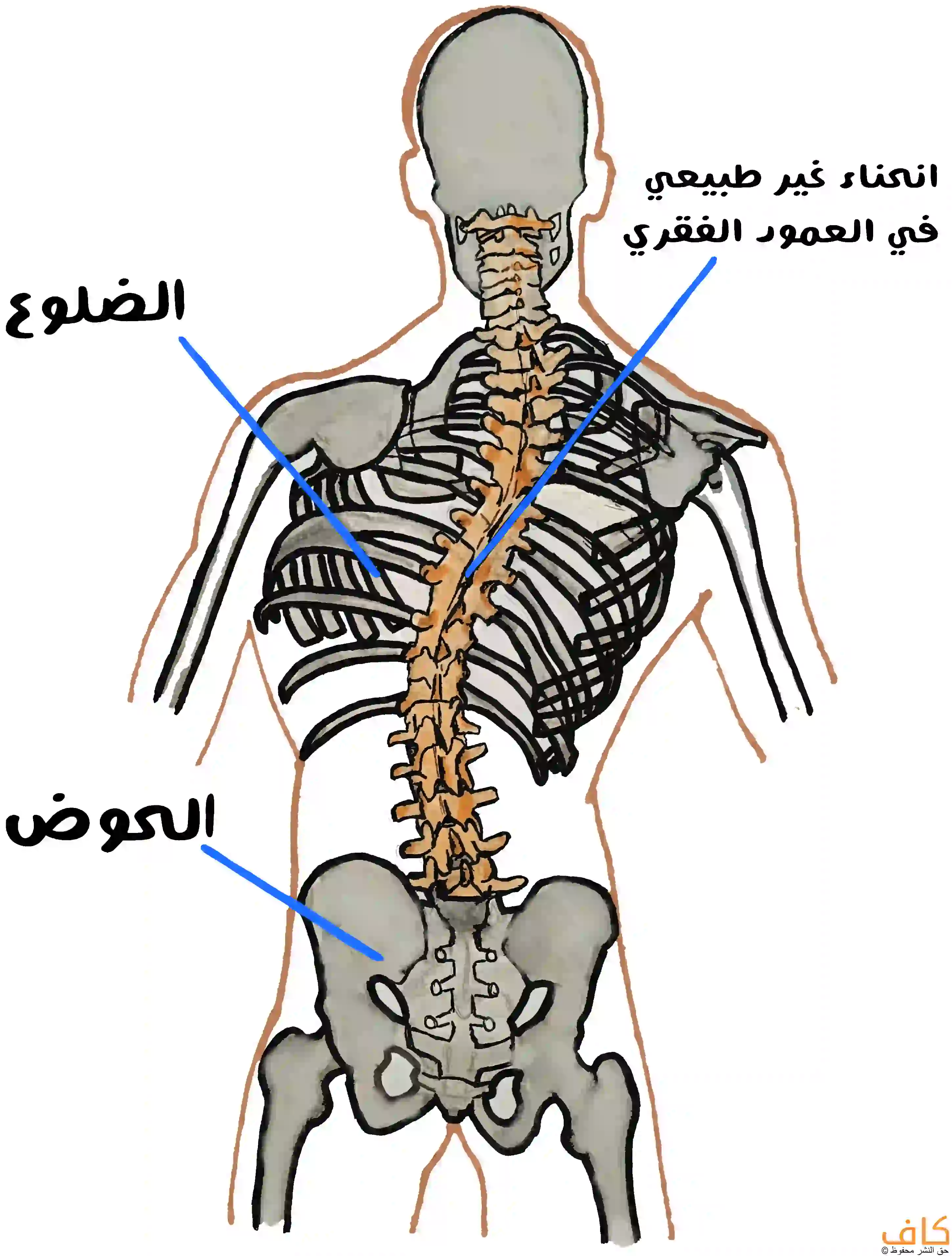 رسم توضيحي يُظهر الهيكل العظمي للجزء الخلفي من جسم الإنسان مع إبراز العمود الفقري بلونٍ مائلٍ إلى البرتقالي يظهر بانحناء جانبي غير طبيعي نحو اليمين، وتوضيح أماكن الضلوع والحوض بخطوطٍ زرقاء، ويُعبّر عن حالة انحناء العمود الفقري (الجنف).