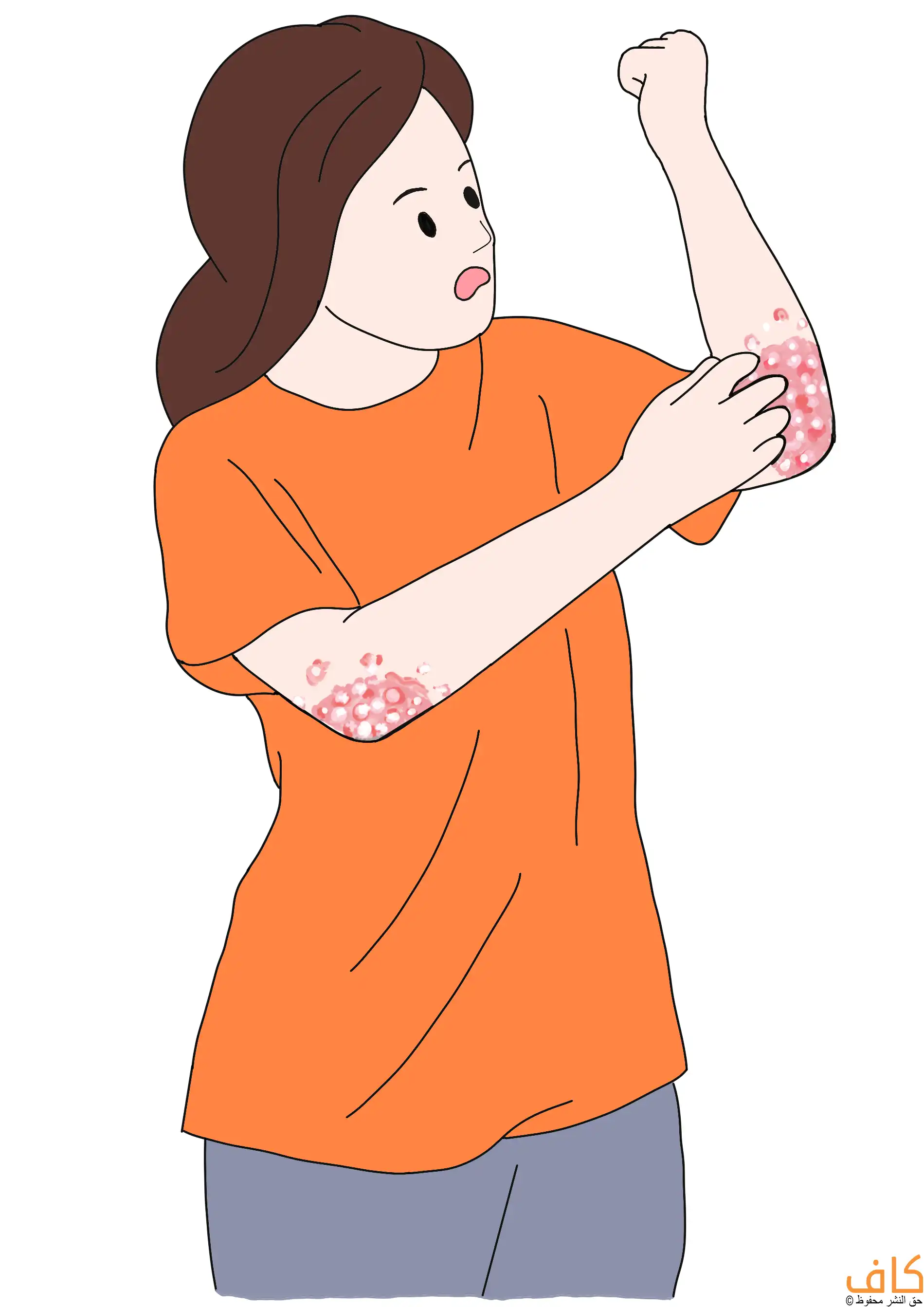 رسمة توضيحية تُظهر امرأة ترتدي قميصًا برتقاليًا، تنظر إلى ذراعها وتحديداً أسفل كوع يدها بينما تقوم بحكّ منطقة حمراء مليئة ببقع قشرية بيضاء منتشرة على كلا المرفقين، في إشارة إلى إصابة جلدية مزمنة.