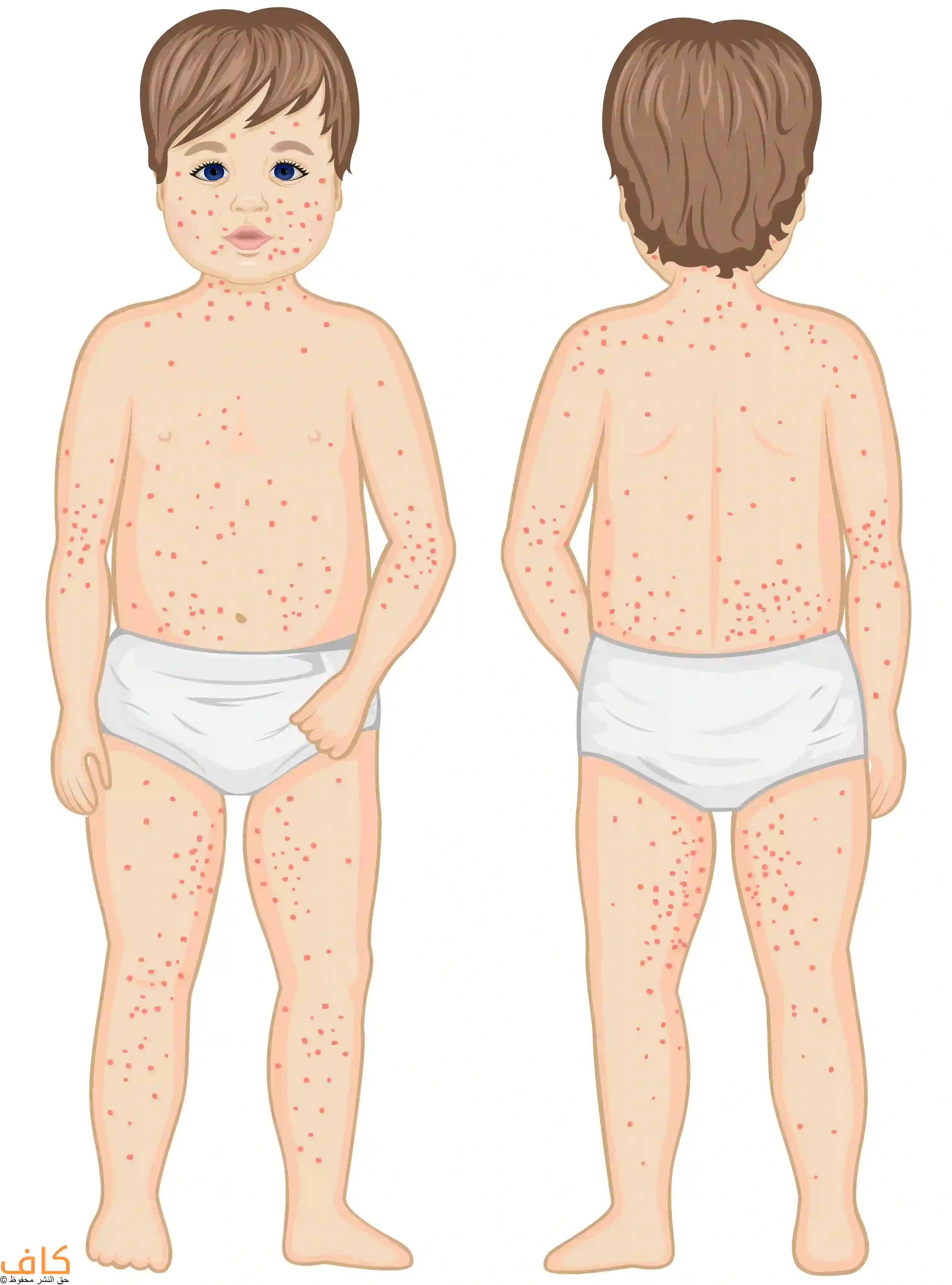 رسم توضيحي يُظهر طفلاً من الأمام والخلف يعاني من طفح جلدي أحمر اللون منتشر على الوجه والصدر والبطن والظهر والأطراف، ويُعبّر الرسم عن الشكل الجلدي المميز للإصابة بالحصبة الألمانية عند الأطفال.