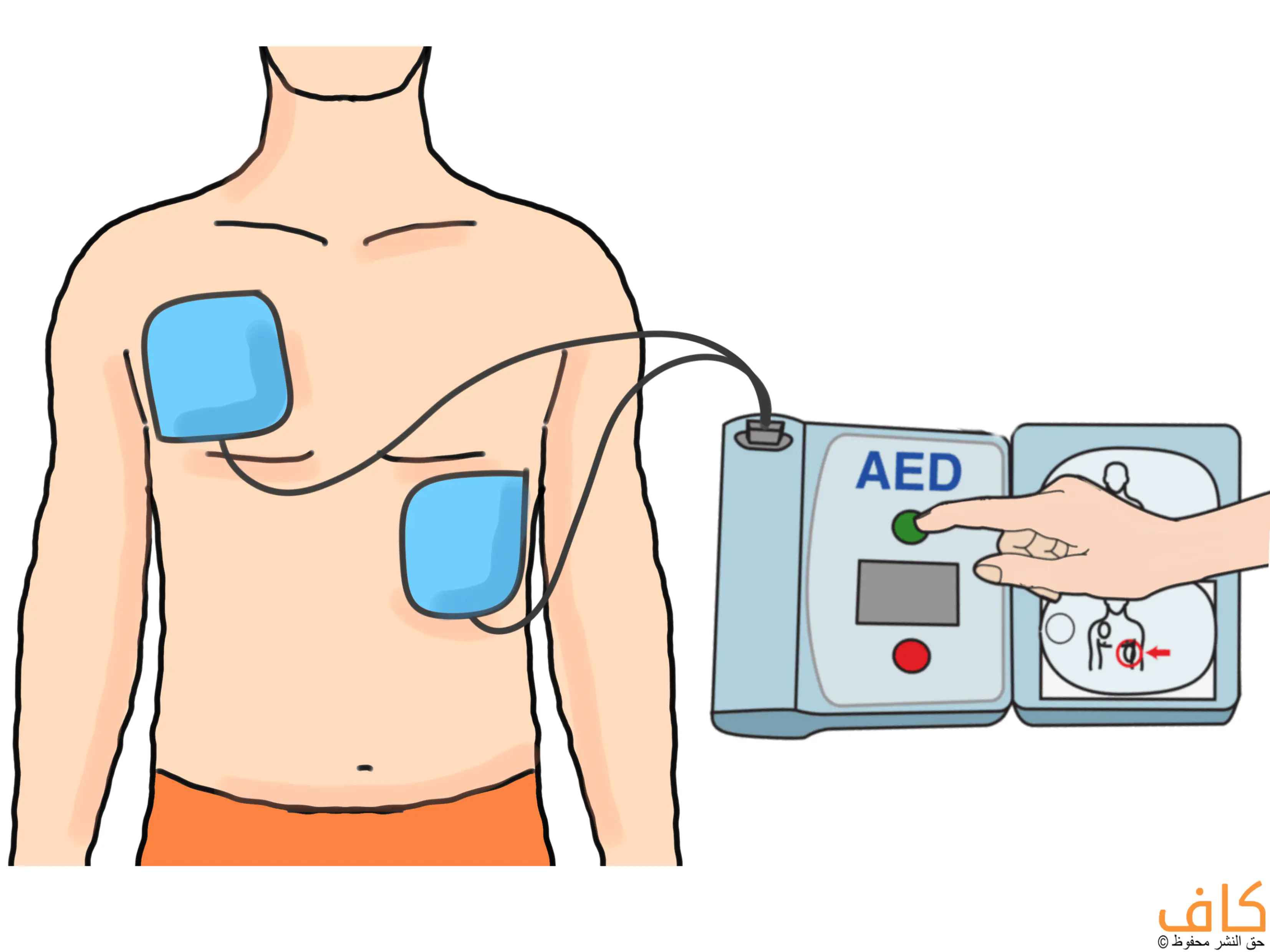 رسم توضيحي يُظهر شخصًا موضوعًا عليه قطعتان لاصقتان لجهاز إزالة الرجفان على الصدر، بينما تظهر يد تضغط على زر في جهاز AED المتصل باللصقات عبر أسلاك. ويُعبّر الرسم عن طريقة استخدام جهاز نازع الرجفان أثناء الإنعاش القلبي الرئوي.
