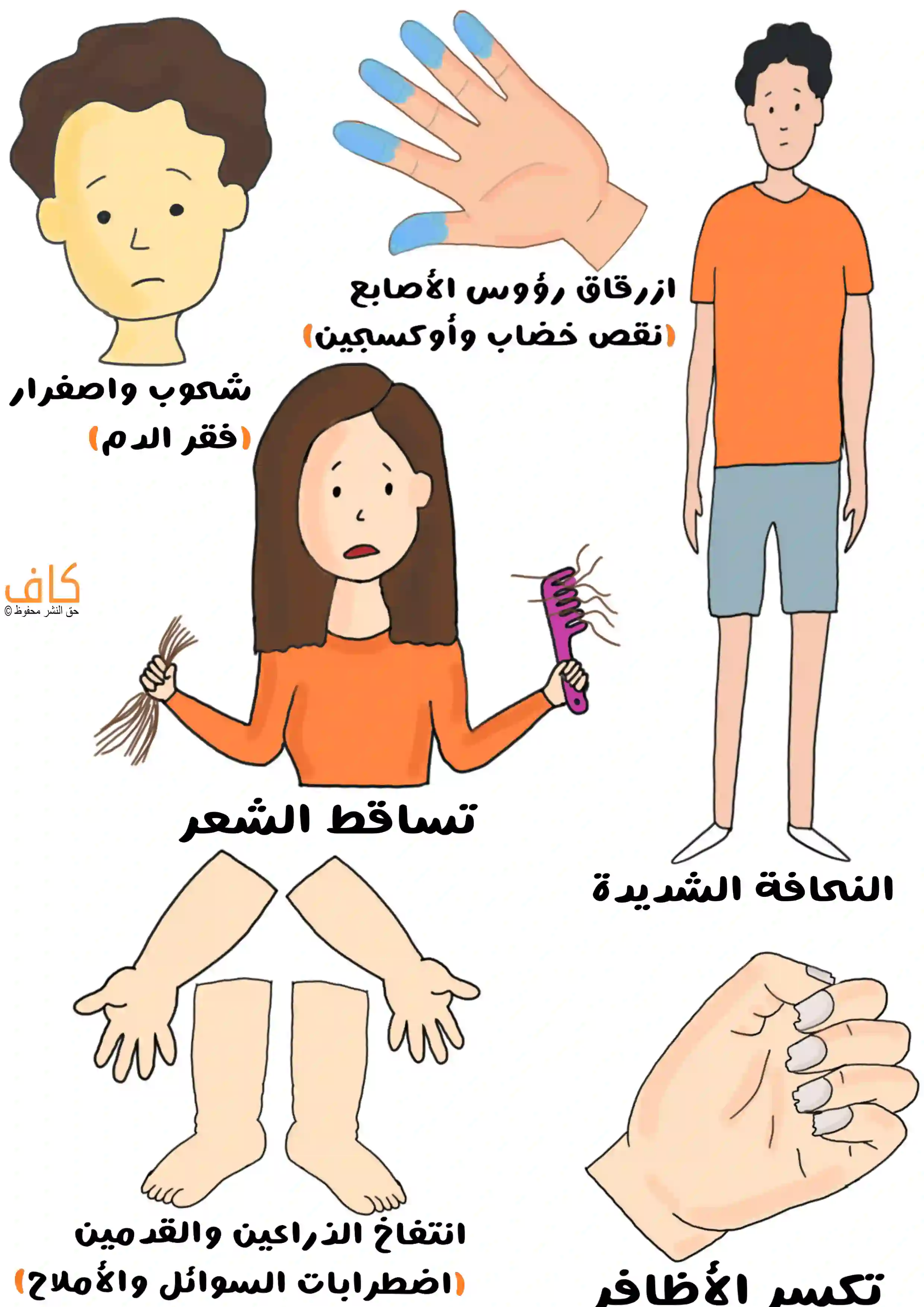 رسم توضيحي يبيّن أعراض القهم العصبي، ويشمل شحوب واصفرار الوجه، ازرقاق رؤوس الأصابع، تساقط الشعر، نحافة شديدة في الجسم، تورم الذراعين والقدمين، وتكسر الأظافر.