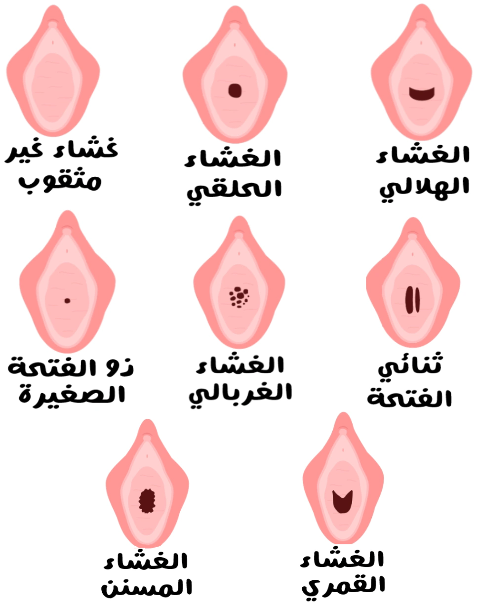 أنواع غِشاء البكارة