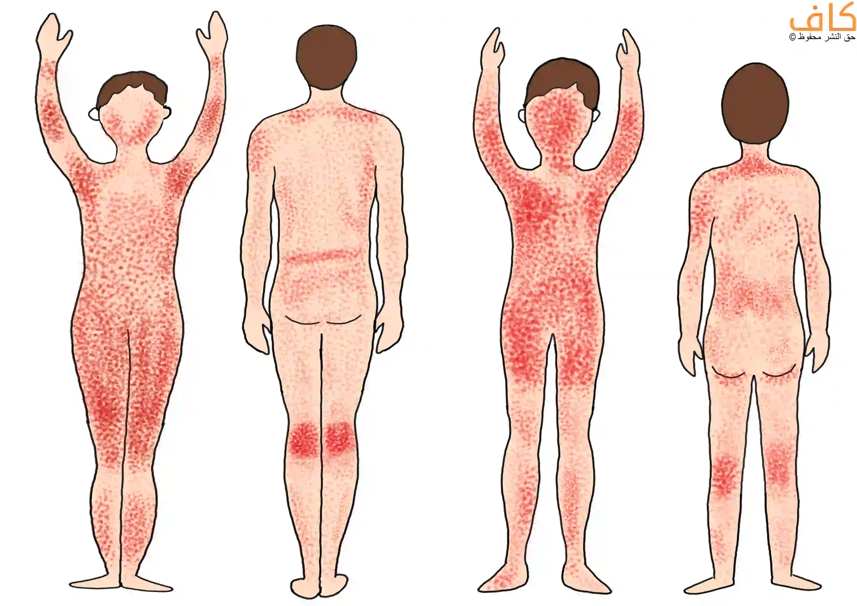 رسم توضيحي يُظهر أربعة أجسام بشرية من الأمام والخلف لشخصين بالغين وشخصين يافعين، مع انتشار بقع حمراء منقطة على مناطق مختلفة من الجلد تشمل الوجه والذراعين والجذع والفخذين وخلف الركبتين وأسفل الظهر، ويُعبّر عن الأماكن التي يلدغ بها القراد على جسم الإنسان.