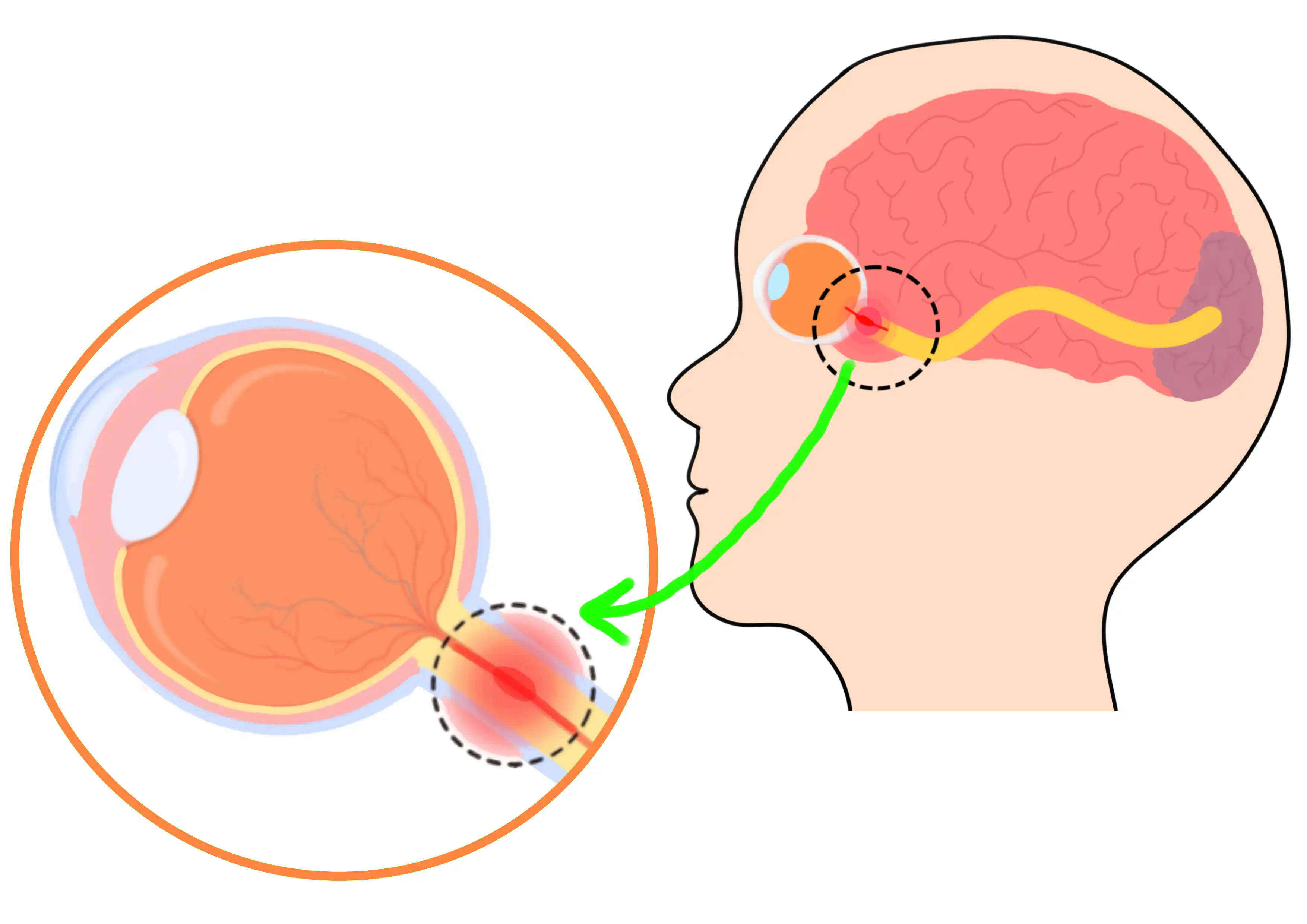 التهاب العصب البصري