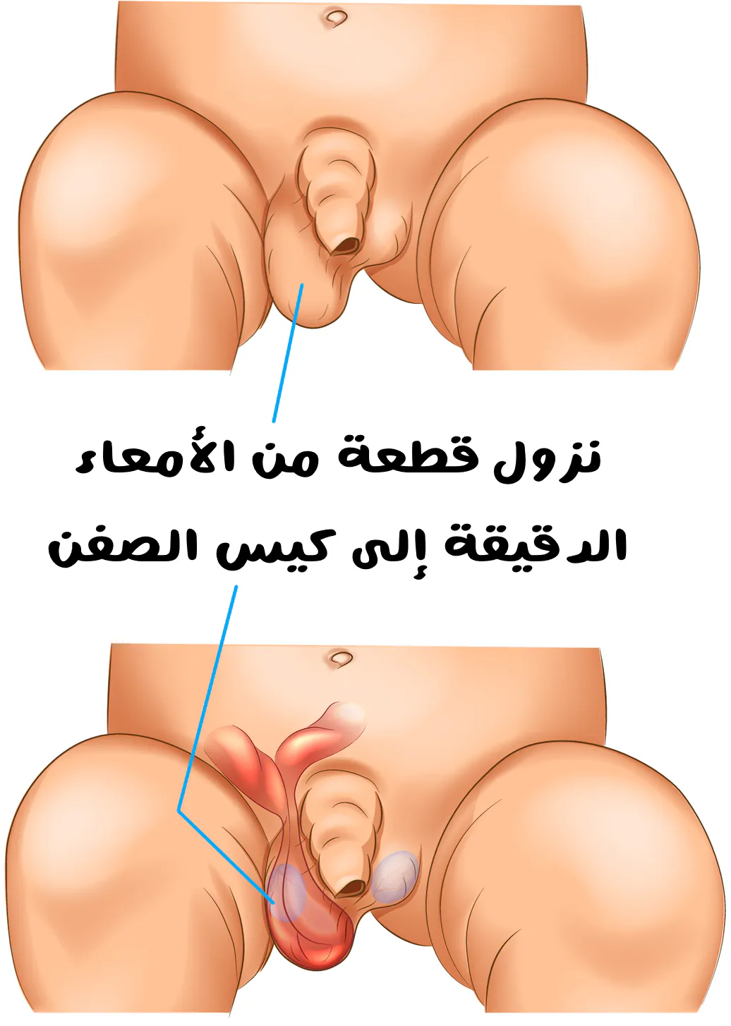 الفتق الإربي عند الأطفال