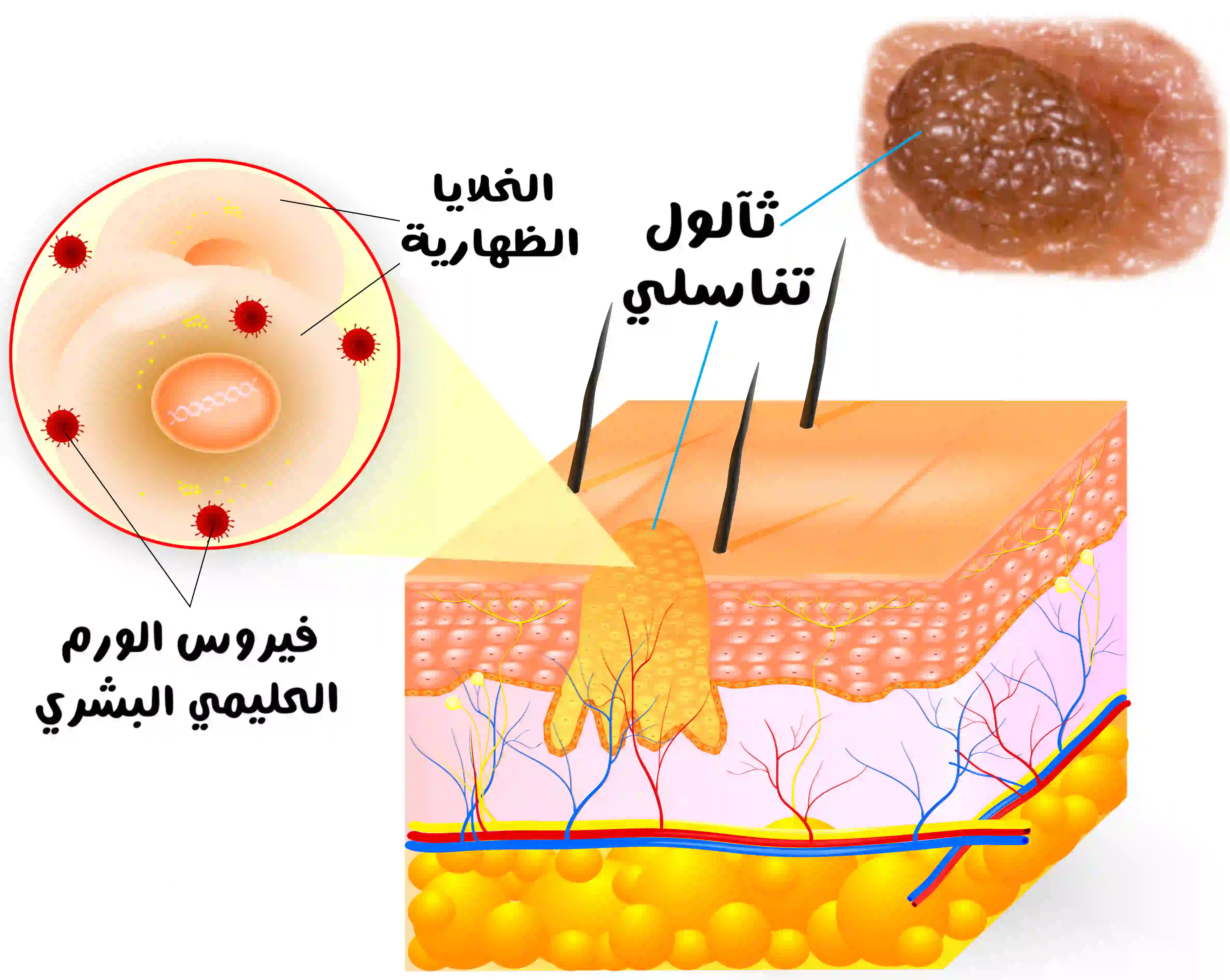 شكل الثآلول تحت الجلد