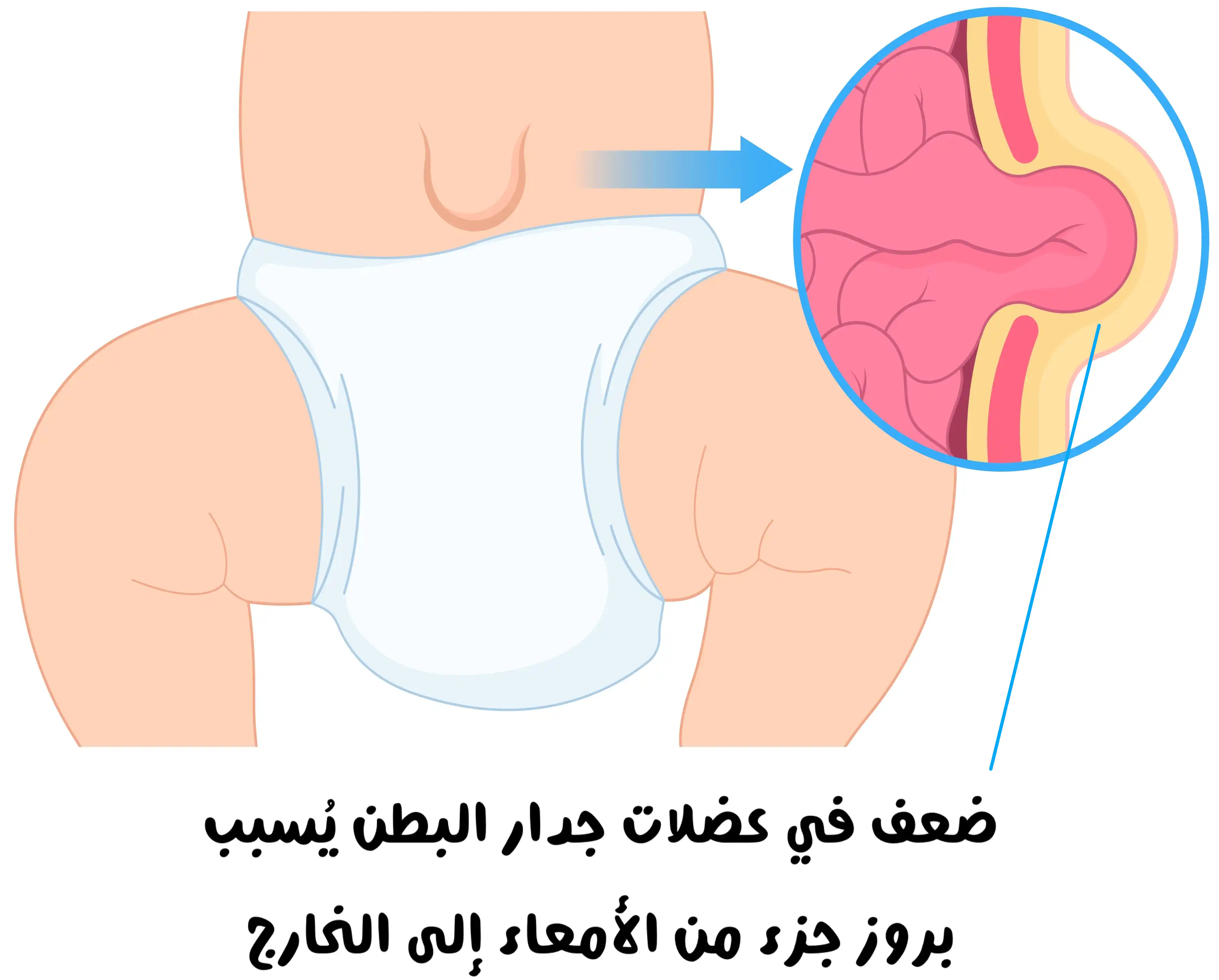 شكل الفتق السري عند الأطفال