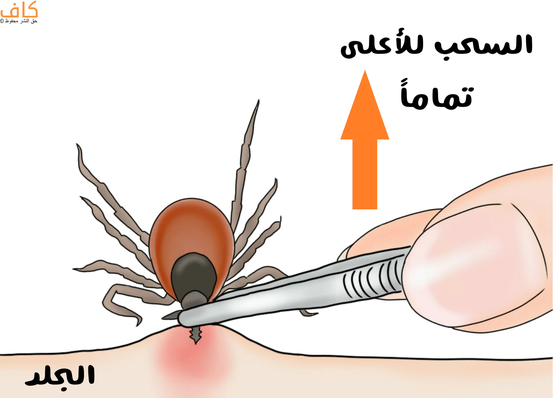 رسم توضيحي يُظهر قرادًا مثبتًا في جلد الإنسان مع احمرار موضعي، وملقطًا معدنيًا يمسك القراد من منطقة الرأس قرب الجلد، مع سهم متجه إلى الأعلى يشير إلى سحب القراد عموديًا بالكامل.