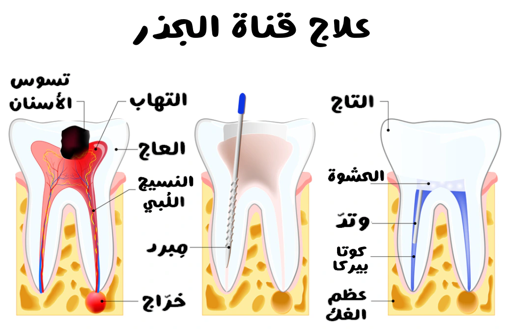 علاج قناة الجذر