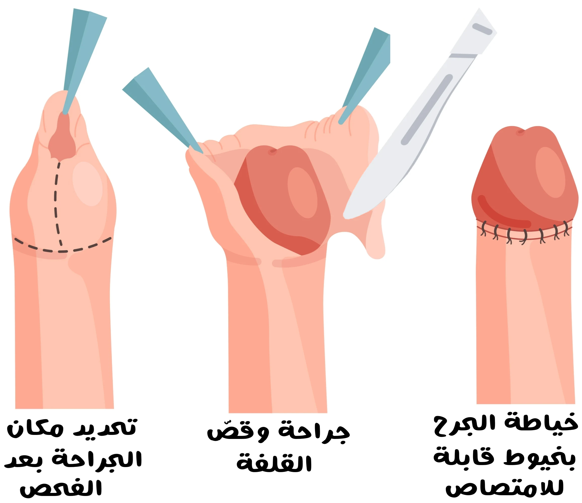 عملية ختان الذكور