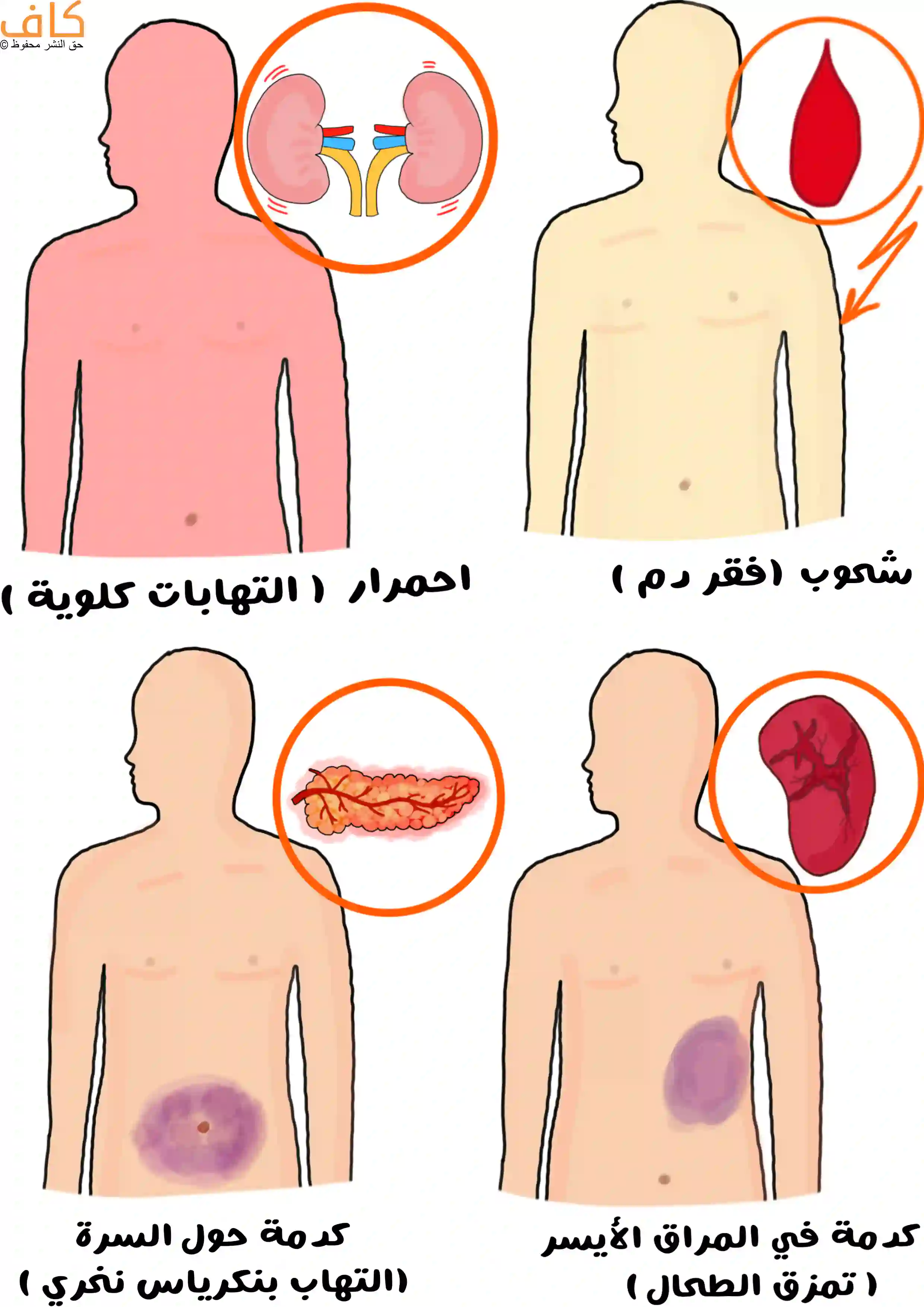 رسم توضيحي يَعرض فحص المريض بالملاحظة السريرية، حيث تظهر أربعة أشخاص مع تغيّرات واضحة في لون الجلد ومناطق محددة من الجسم، تشمل احمرارًا عامًا مرتبطًا بالتهابات كلوية، وشحوبًا يدل على فقر الدم، وكدمة حول السرة تشير إلى التهاب البنكرياس النزفي، وكدمة في المراق الأيسر تدل على تمزق الطحال.