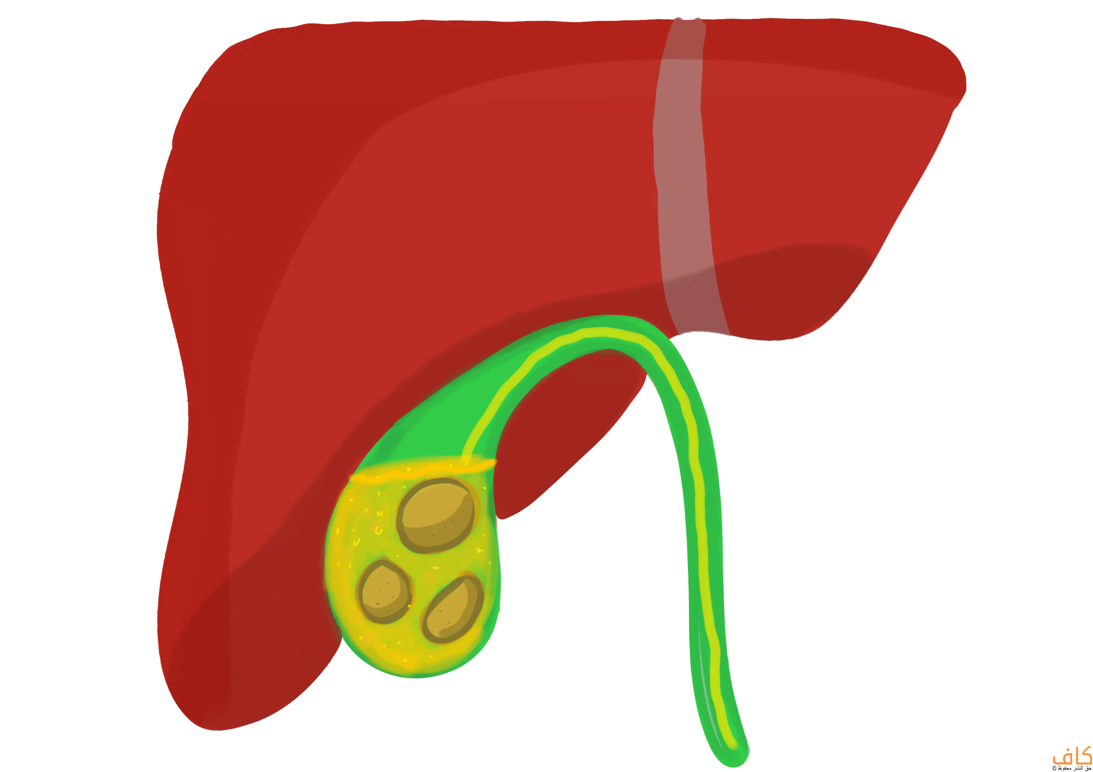 ماهي الحصيات المرارية