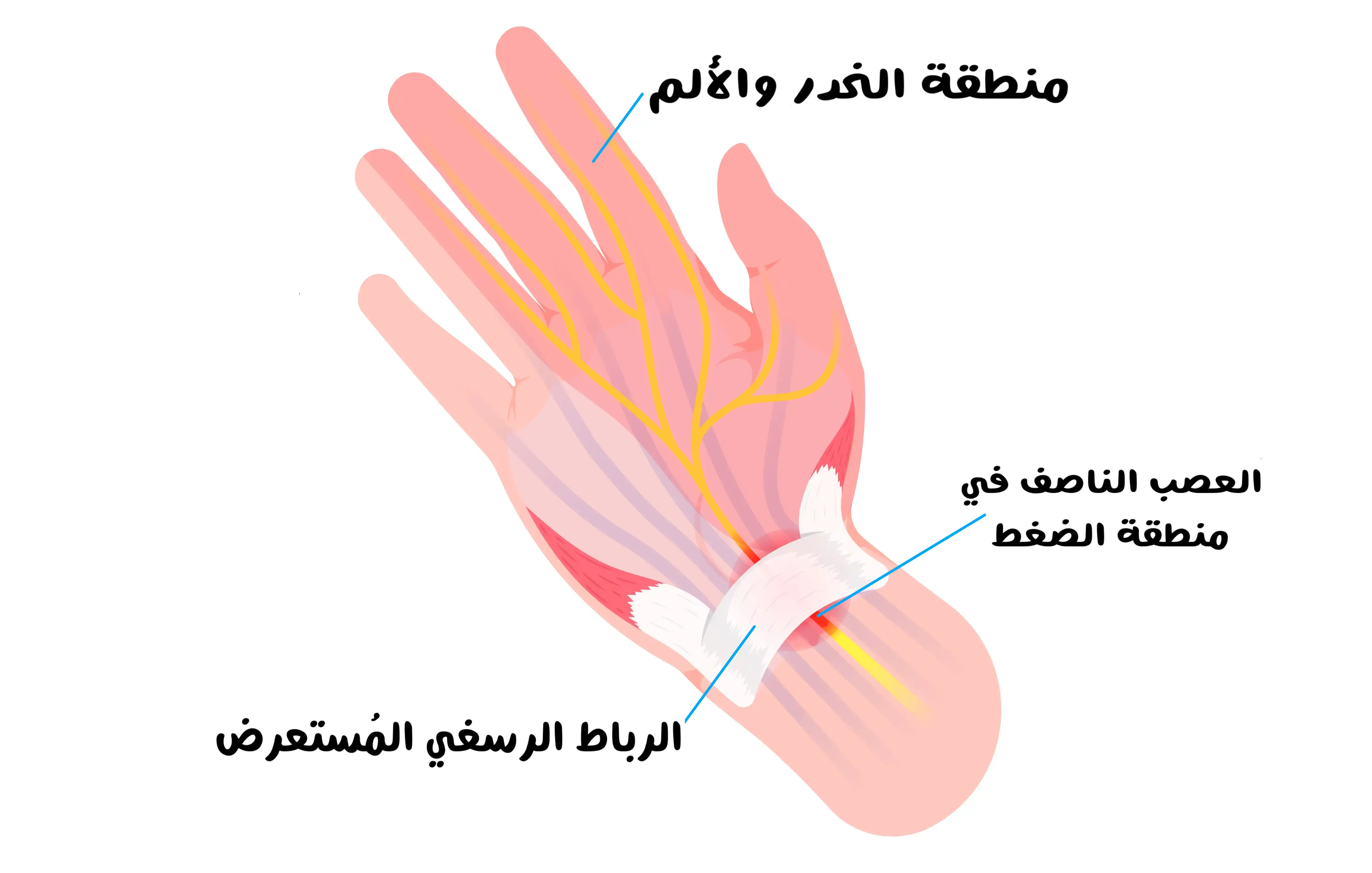 مُتلازمة النفق الرسغي