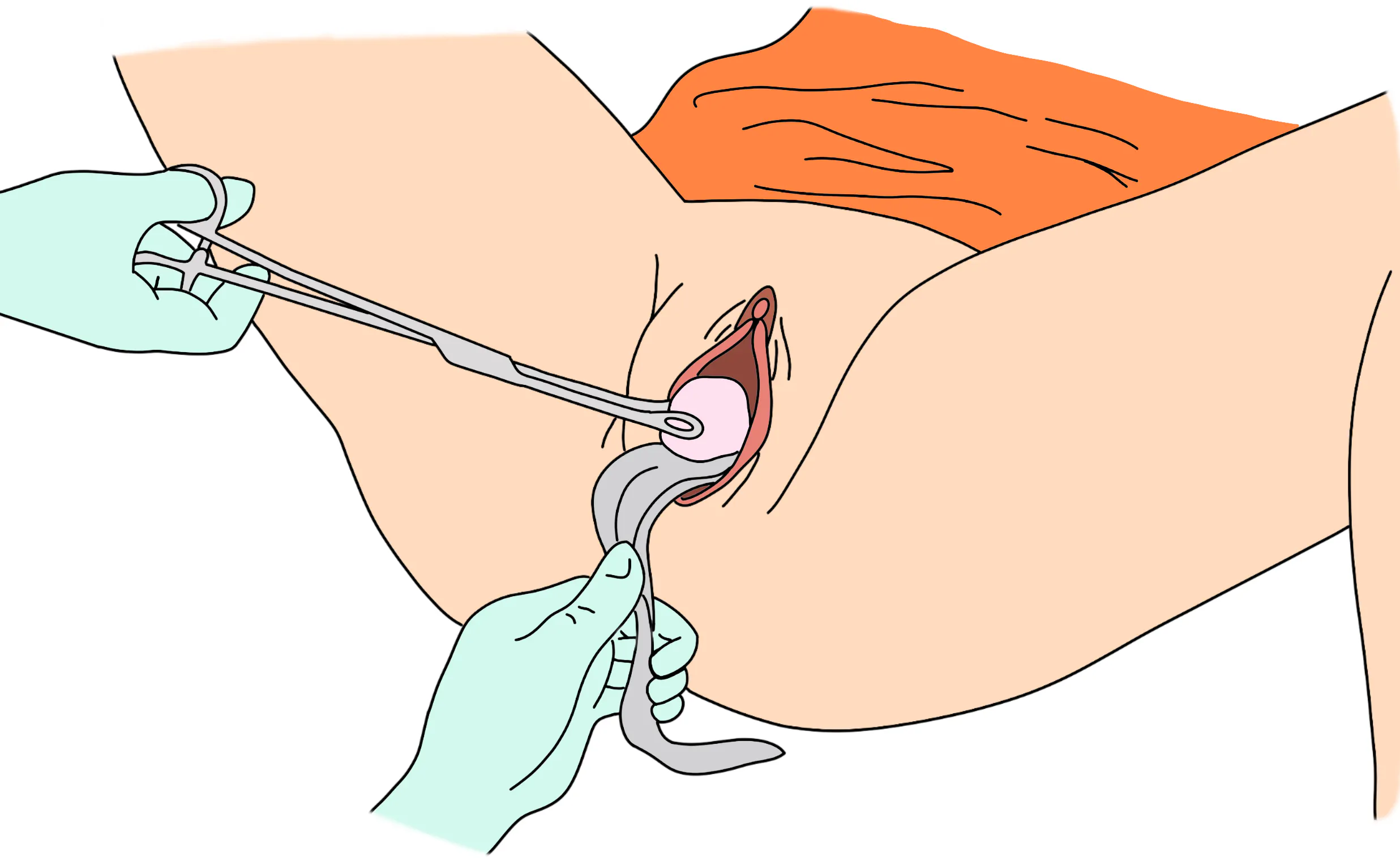 إدخال منظار مهبلي 3