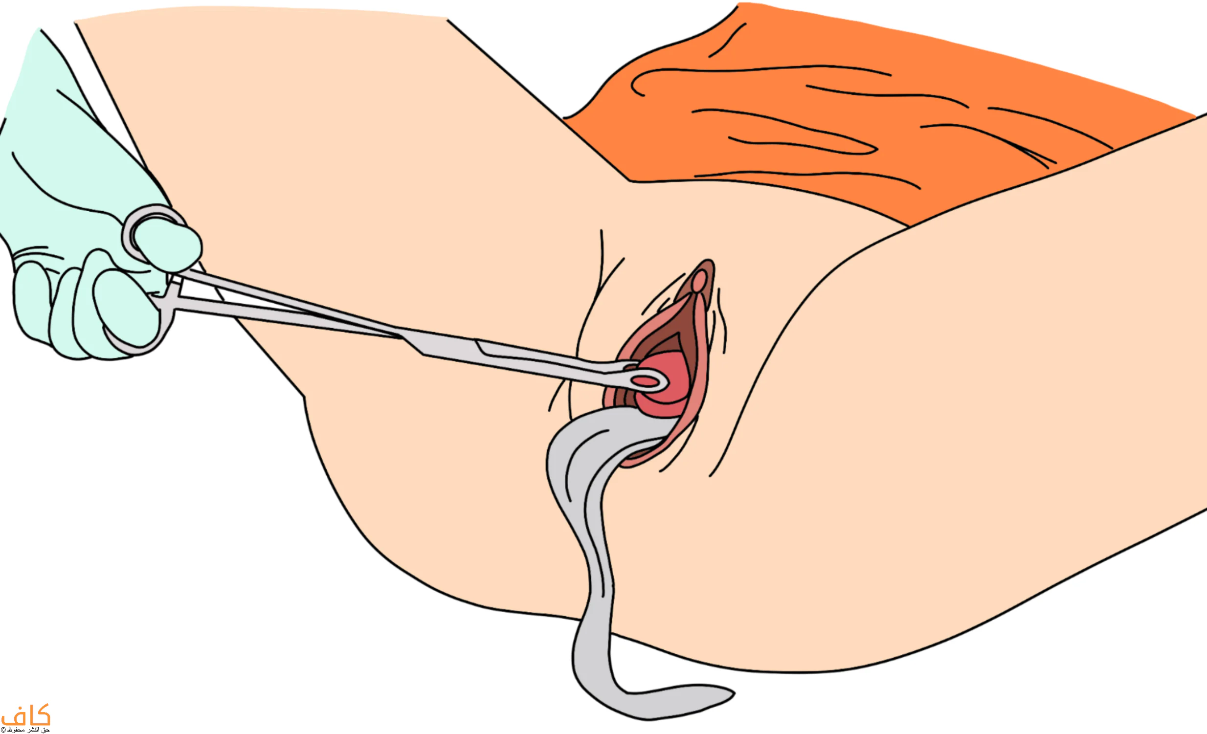 تعقيم عنق الرحم 4