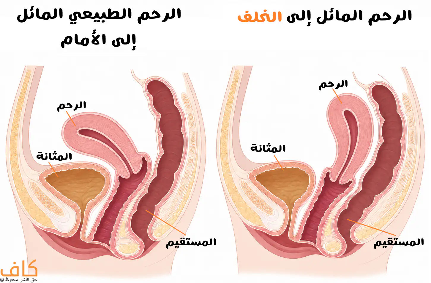 مقارنة تشريحية بين الرحم الطبيعي المائل إلى الأمام فوق المثانة والرحم المائل إلى الخلف باتجاه المستقيم.