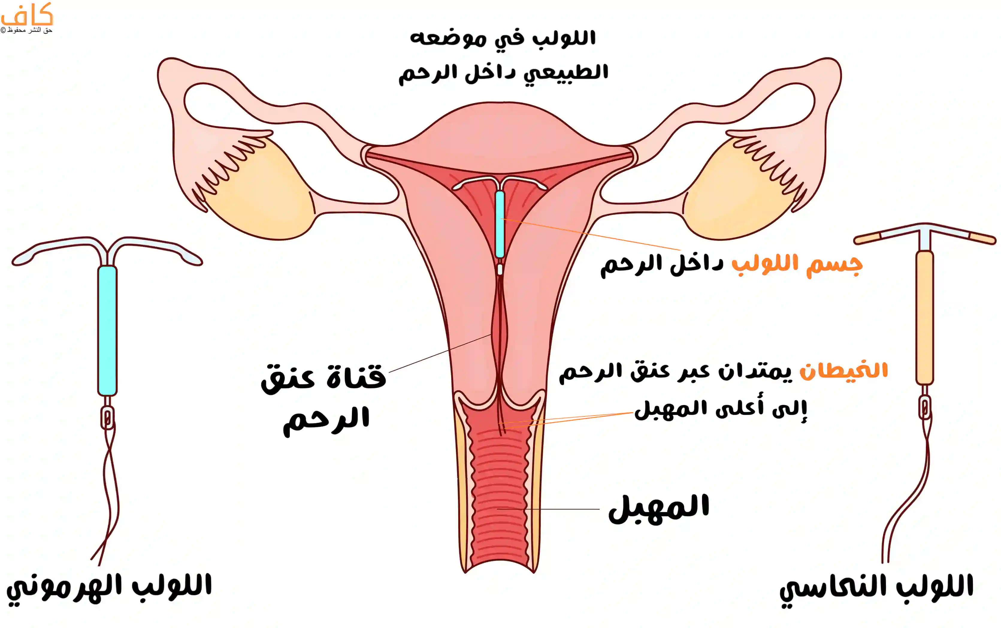 رسم توضيحي يبين شكل اللولب في موضعه الطبيعي داخل الرحم، مع امتداد الخيطين عبر عنق الرحم إلى أعلى المهبل، وإظهار اللولب النحاسي والهرموني.