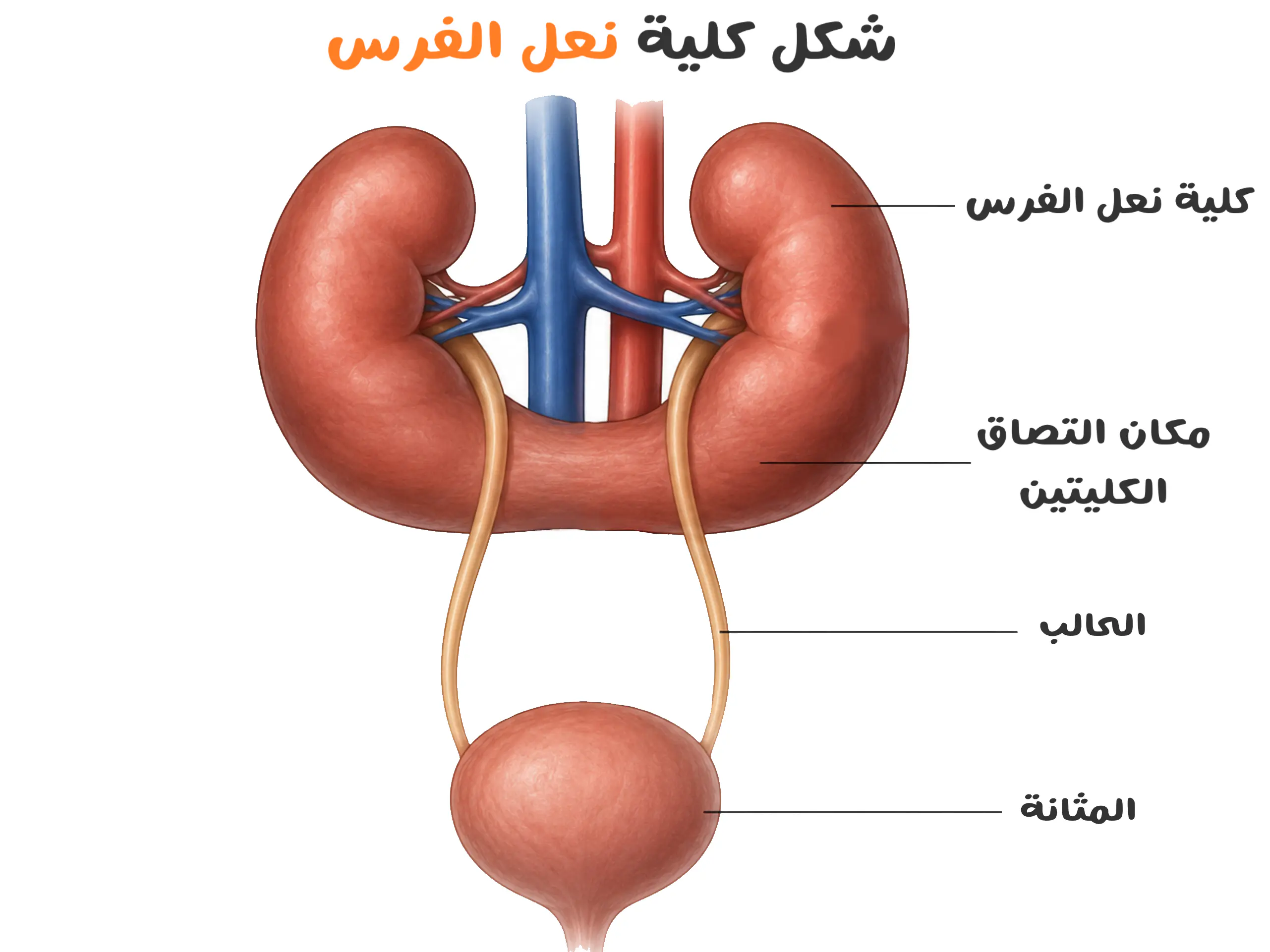 رسم توضيحي يبين شكل كلية نعل الفرس عند الأطفال والتحام الكليتين من الأسفل مع الحالبين والمثانة