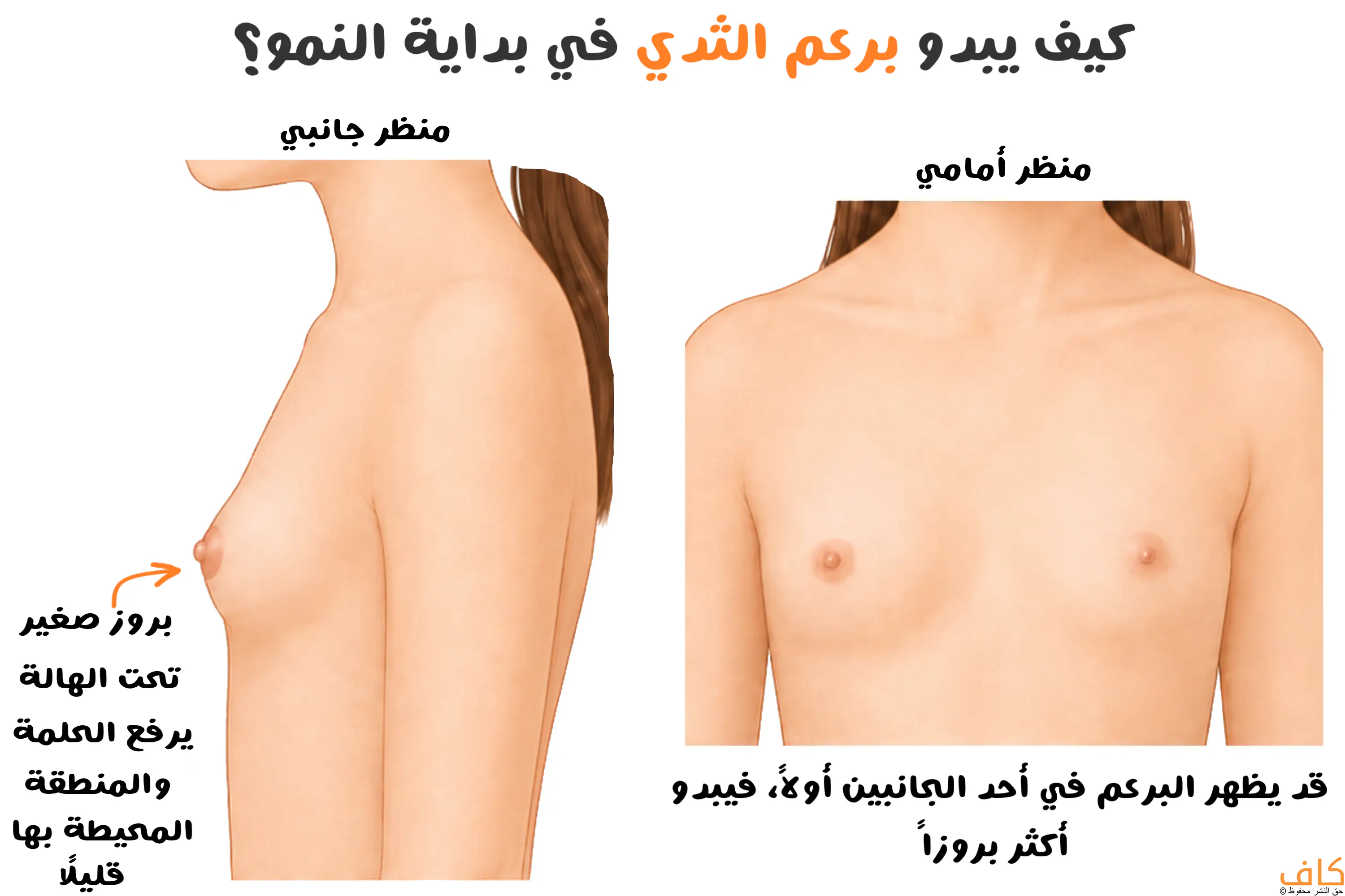 شكل برعم الثدي عند البنات في بداية البلوغ من الأمام والجانب، مع توضيح البروز الصغير تحت الهالة وإمكان ظهوره في أحد الجانبين أولًا.