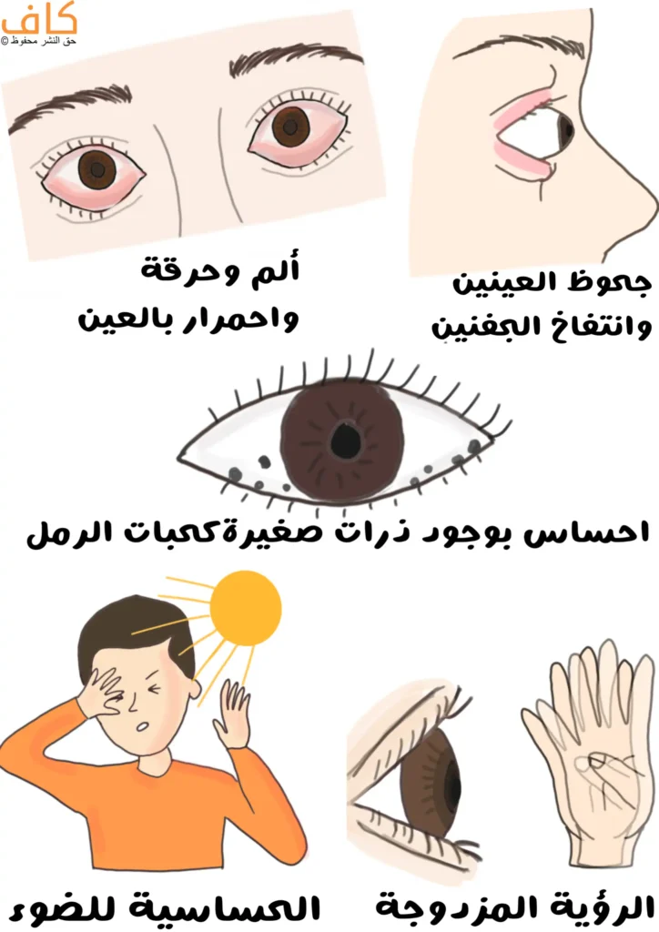 رسم توضيحي يضم عدة مشاهد للعين، تشمل عينين محمرتين والجفون تظهر متورمة، عينًا مع نقاط سوداء صغيرة بداخلها، شخصًا يضع يده على عينه أمام ضوء الشمس الساطع، عينًا تظهر رؤية مزدوجة من خلال ظهور صورتين متجاورتين لكف يد أمامها.