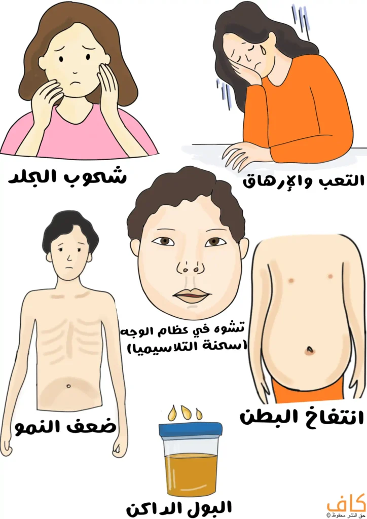رسم توضيحي يُظهر عدة أشخاص يعانون من علامات مختلفة مثل شحوب الجلد، التعب والإرهاق، انتفاخ البطن، ضعف النمو، وتشوه في عظام الوجه مع وعاء بول داكن اللون، ويُعبّر عن الأعراض الجسدية المميزة لمرض الثلاسيميا.